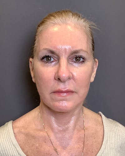 CO2 Full Face Before & After Gallery - Patient 407428 - Image 2