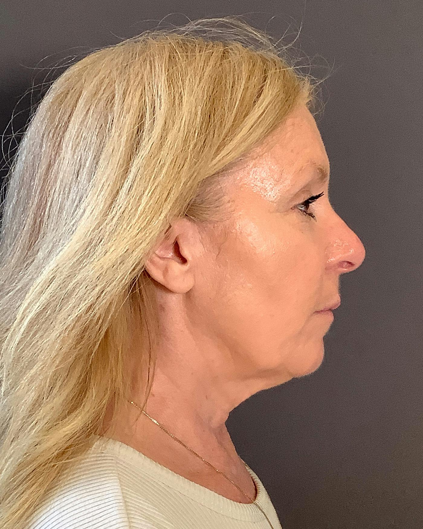 CO2 Full Face Before & After Gallery - Patient 407428 - Image 5
