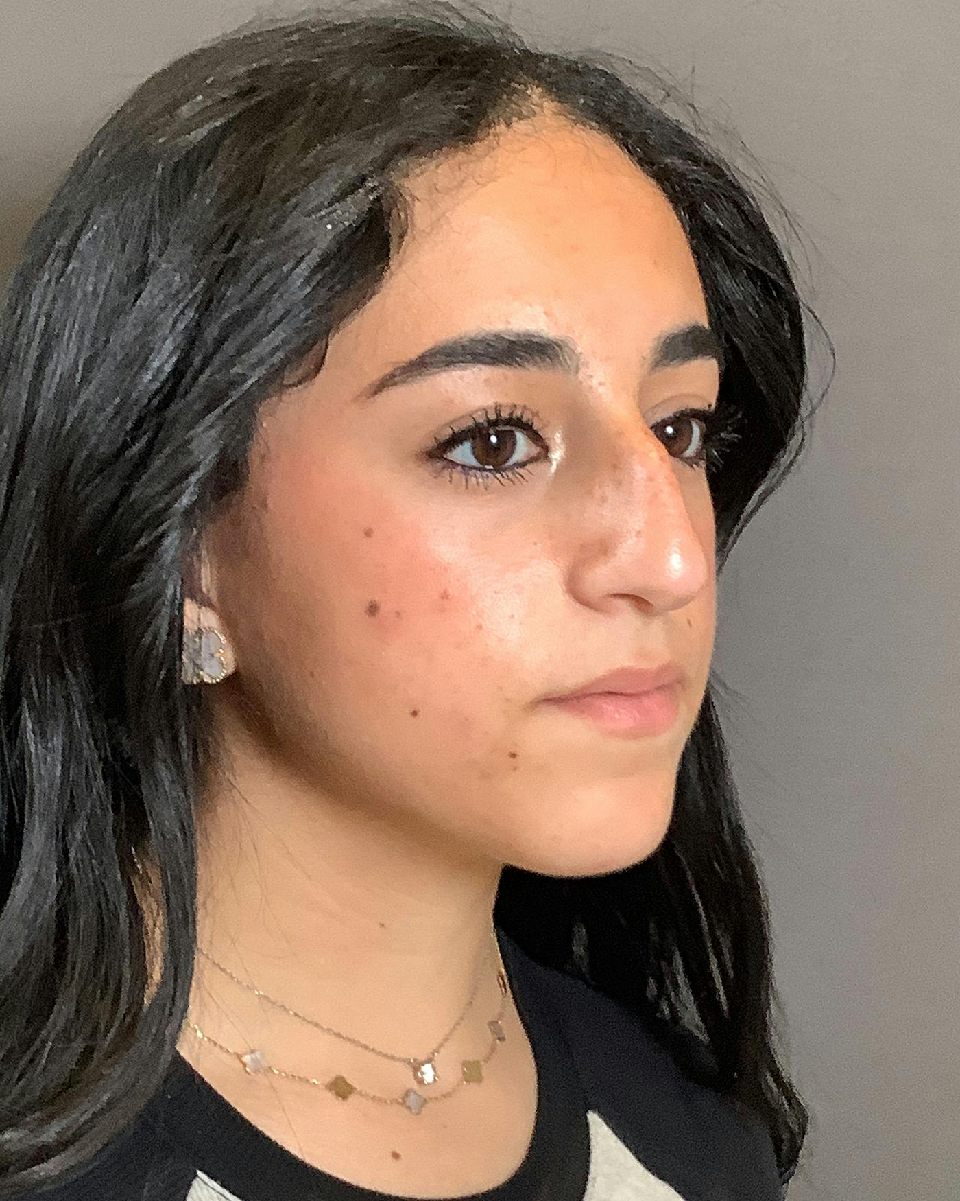 Rhinoplasty Before & After Gallery - Patient 192754 - Image 1