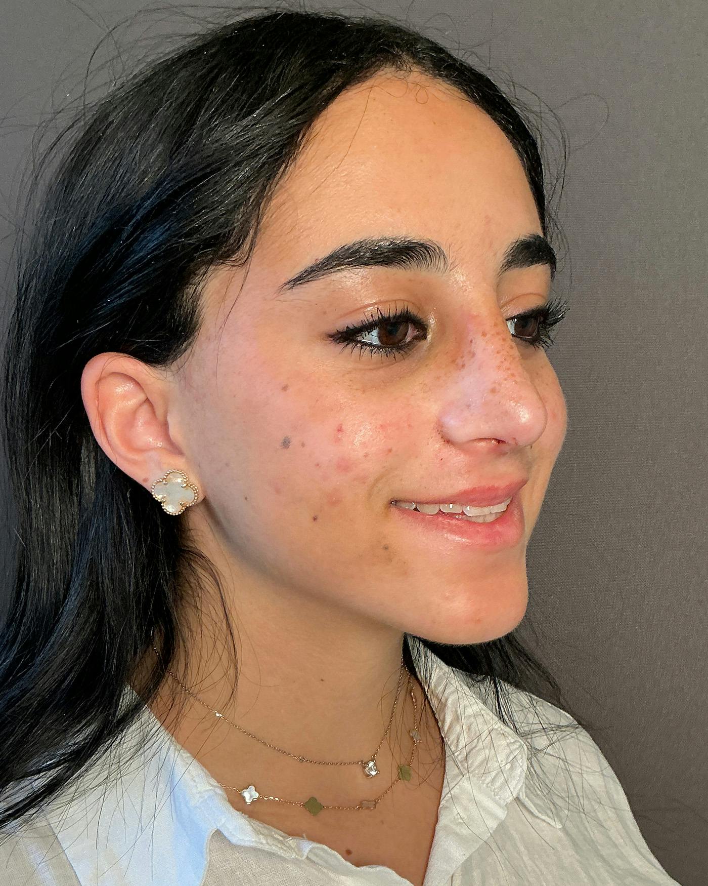 Rhinoplasty Before & After Gallery - Patient 192754 - Image 2