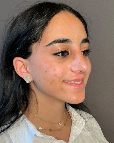 Rhinoplasty Before & After Gallery - Patient 192754 - Image 2