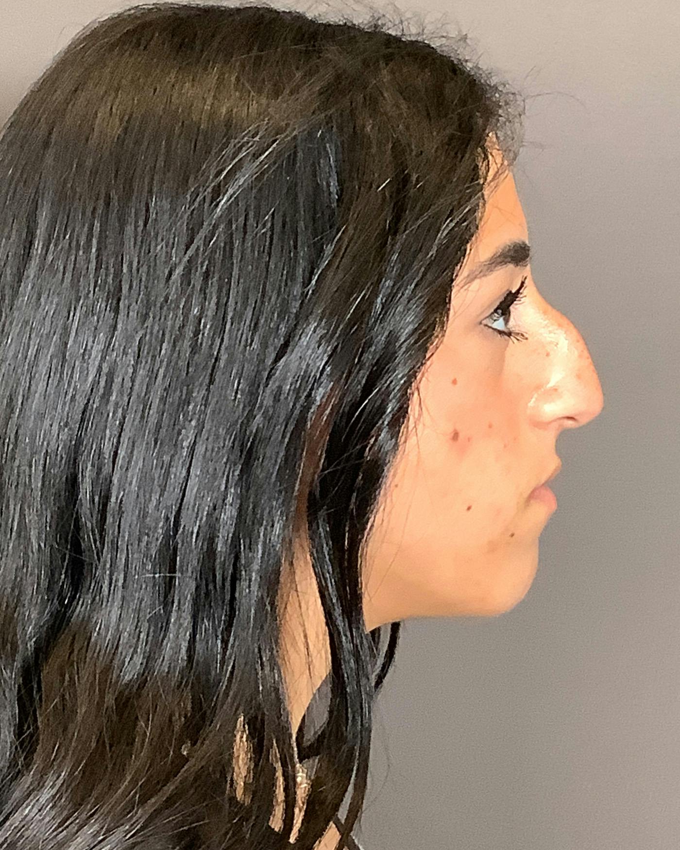 Rhinoplasty Before & After Gallery - Patient 192754 - Image 3