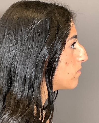 Rhinoplasty Before & After Gallery - Patient 192754 - Image 1