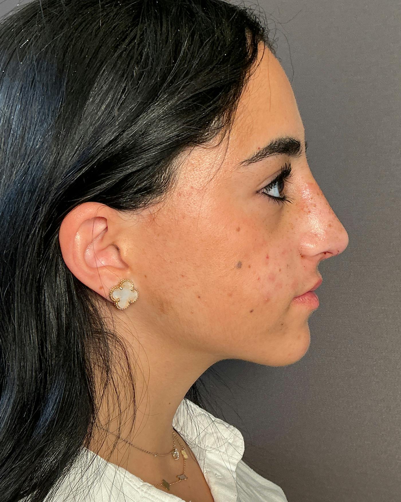 Rhinoplasty Before & After Gallery - Patient 192754 - Image 4
