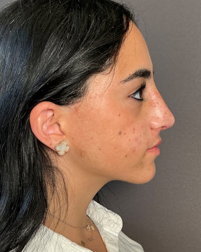 Rhinoplasty Before & After Gallery - Patient 192754 - Image 2