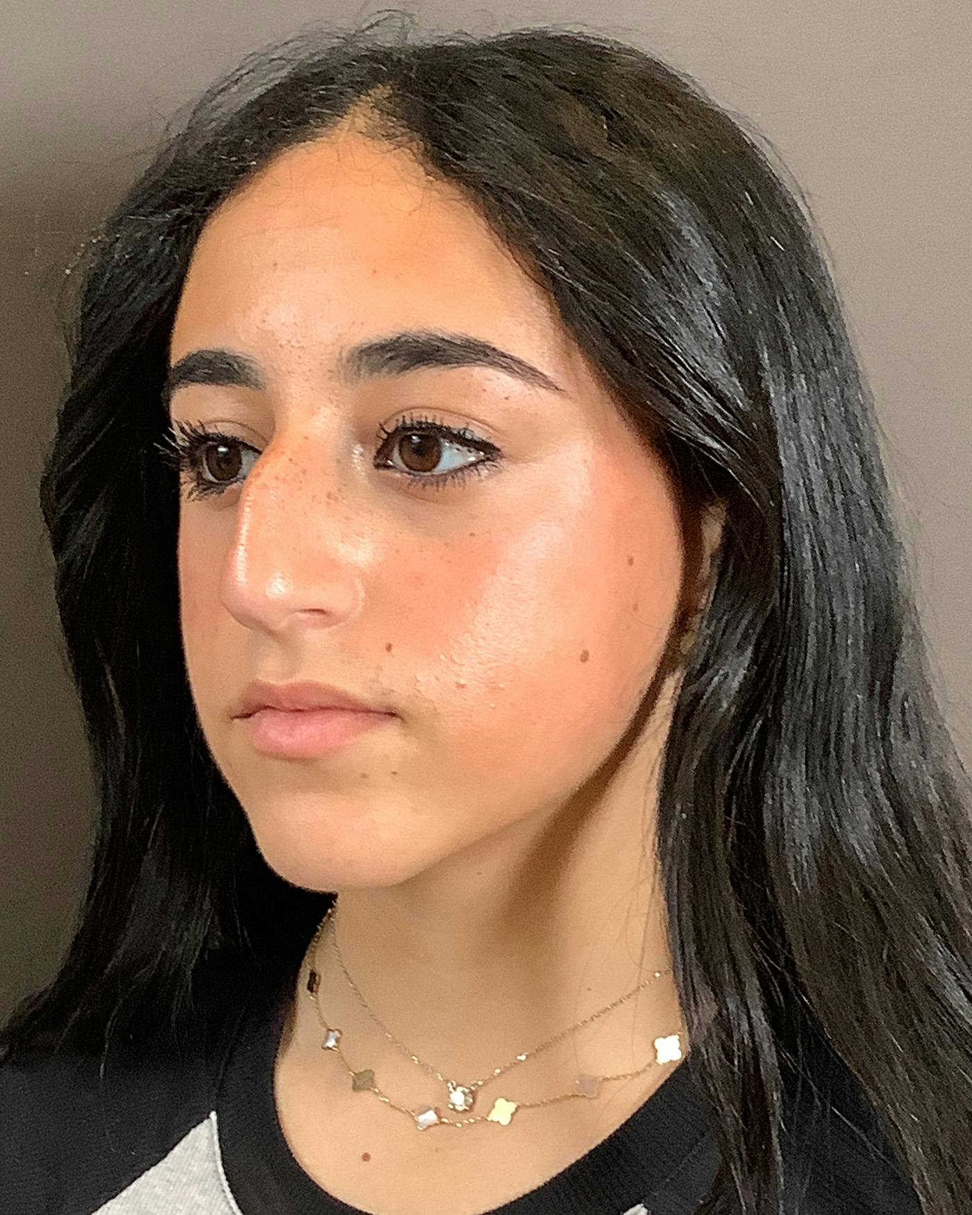 Rhinoplasty Before & After Gallery - Patient 192754 - Image 5