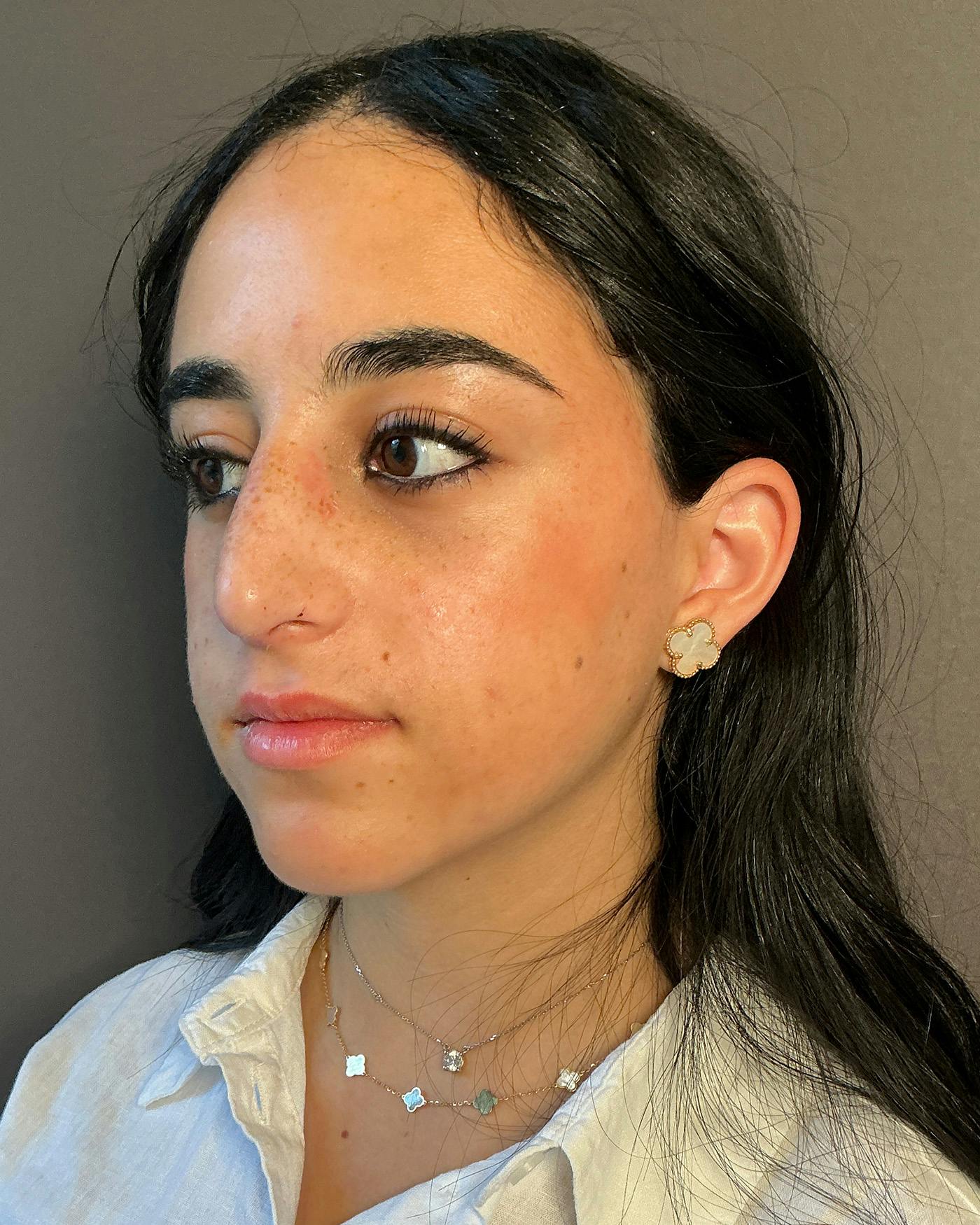Rhinoplasty Before & After Gallery - Patient 192754 - Image 6
