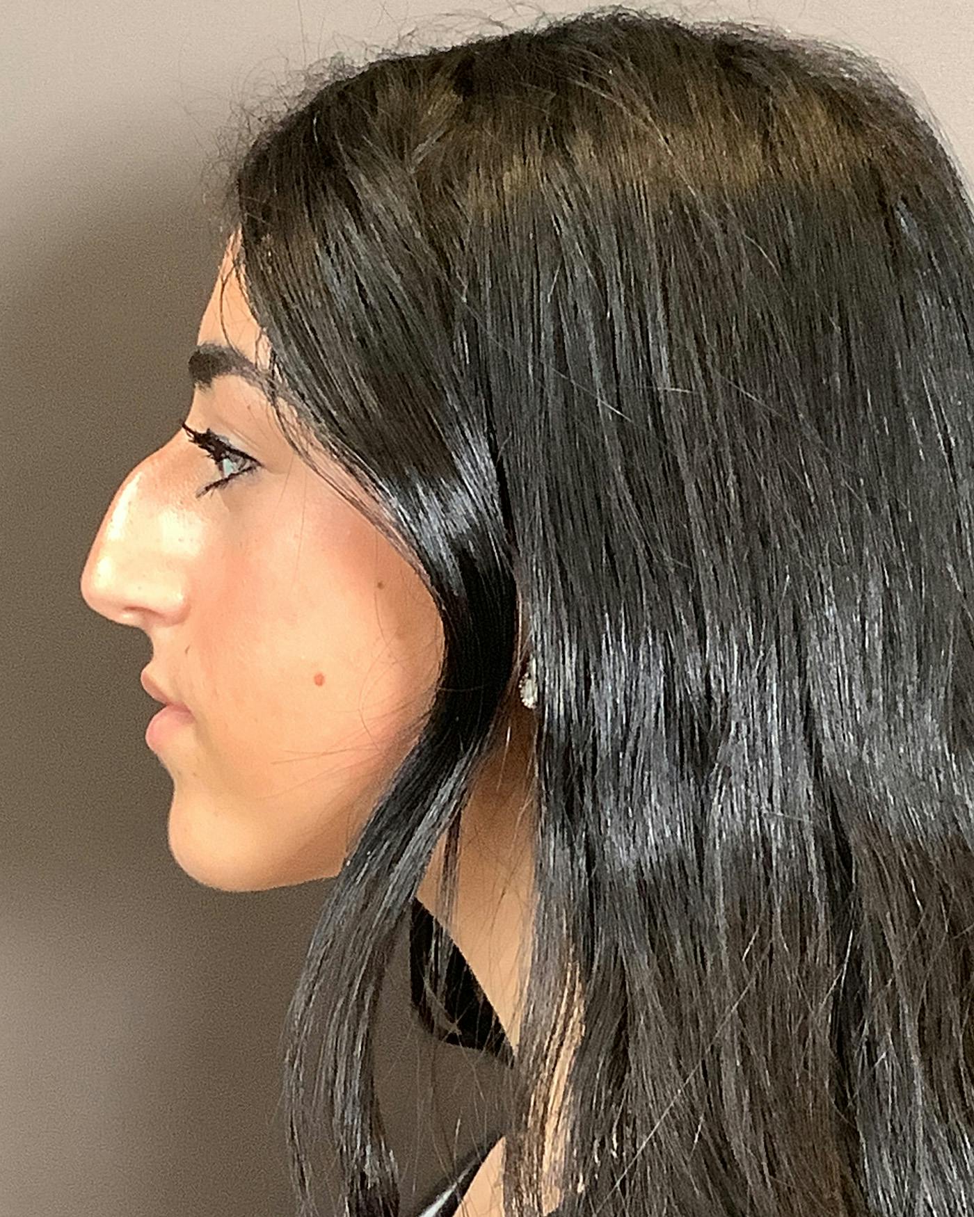 Rhinoplasty Before & After Gallery - Patient 192754 - Image 7