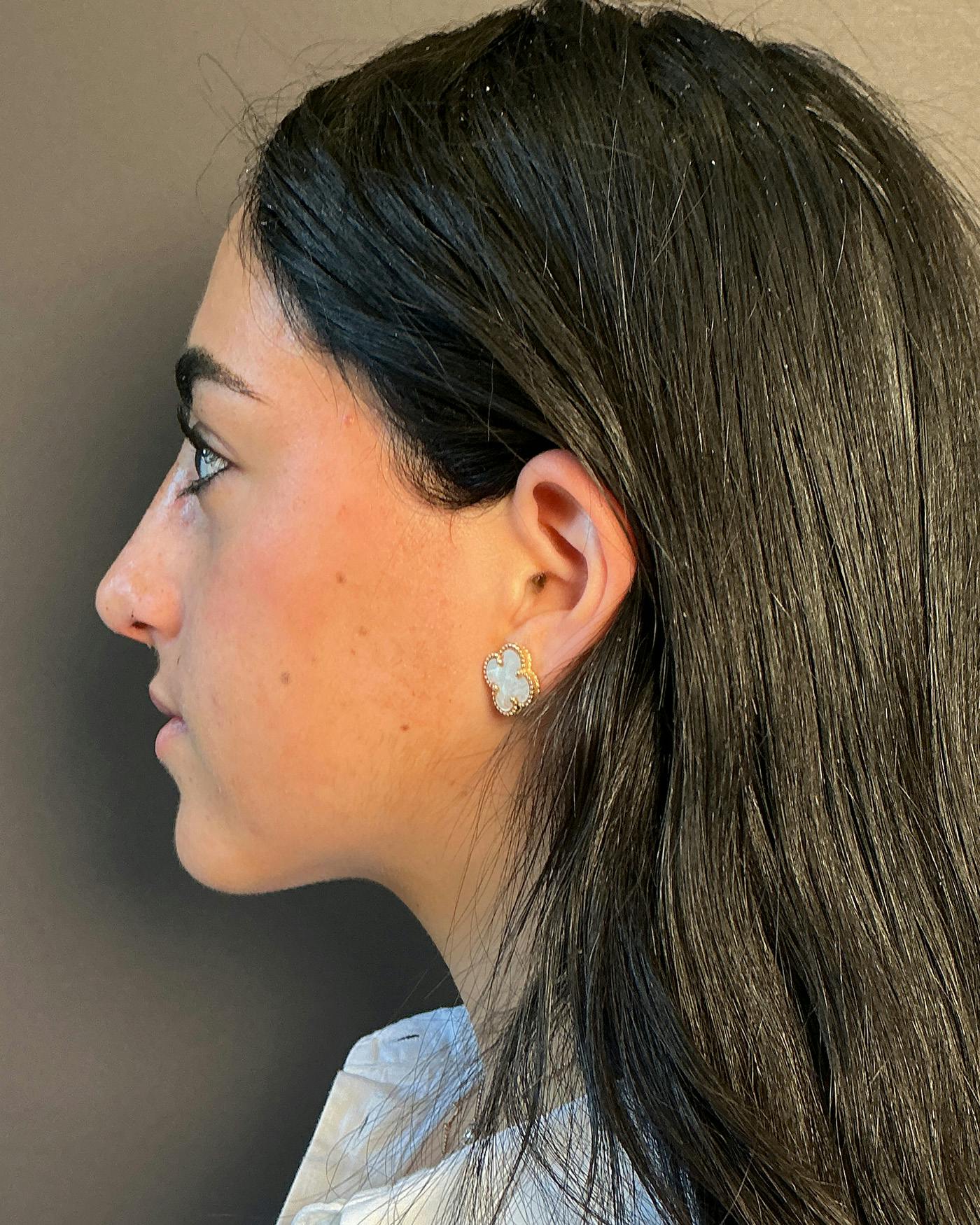 Rhinoplasty Before & After Gallery - Patient 192754 - Image 8