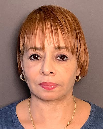 Facial Fat Transfer Before & After Gallery - Patient 256345 - Image 1