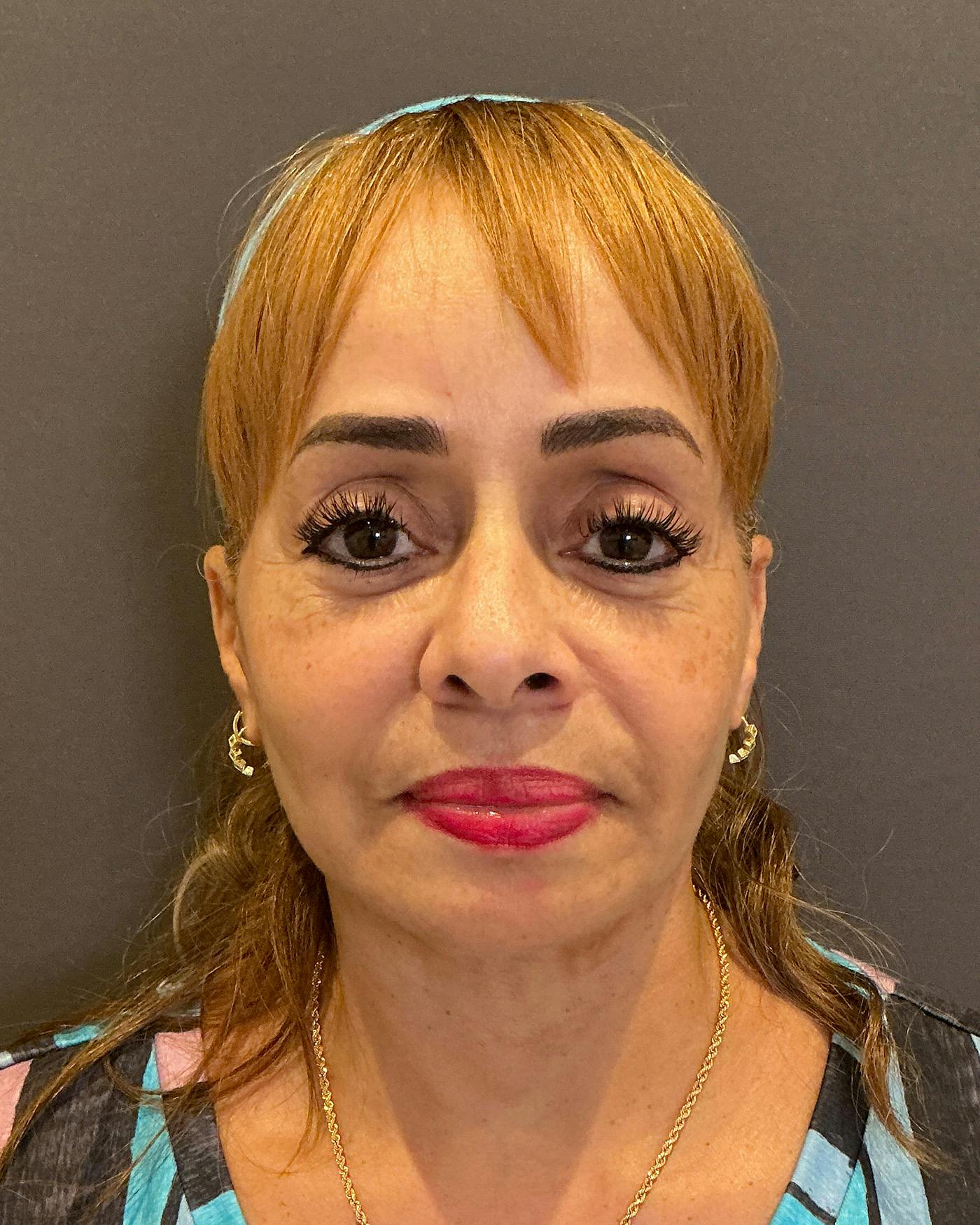 Facial Fat Transfer Before & After Gallery - Patient 256345 - Image 2