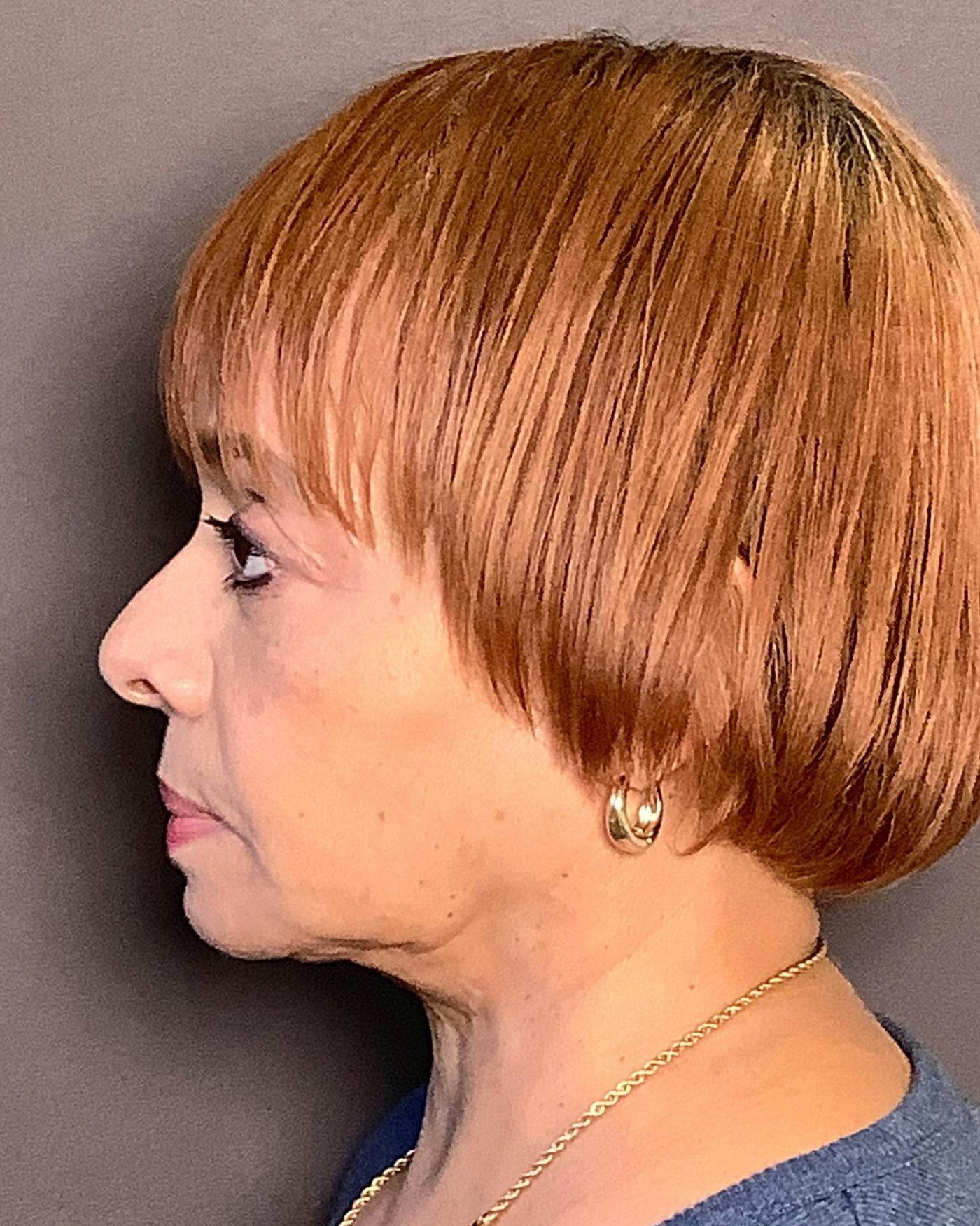 Facial Fat Transfer Before & After Gallery - Patient 256345 - Image 9