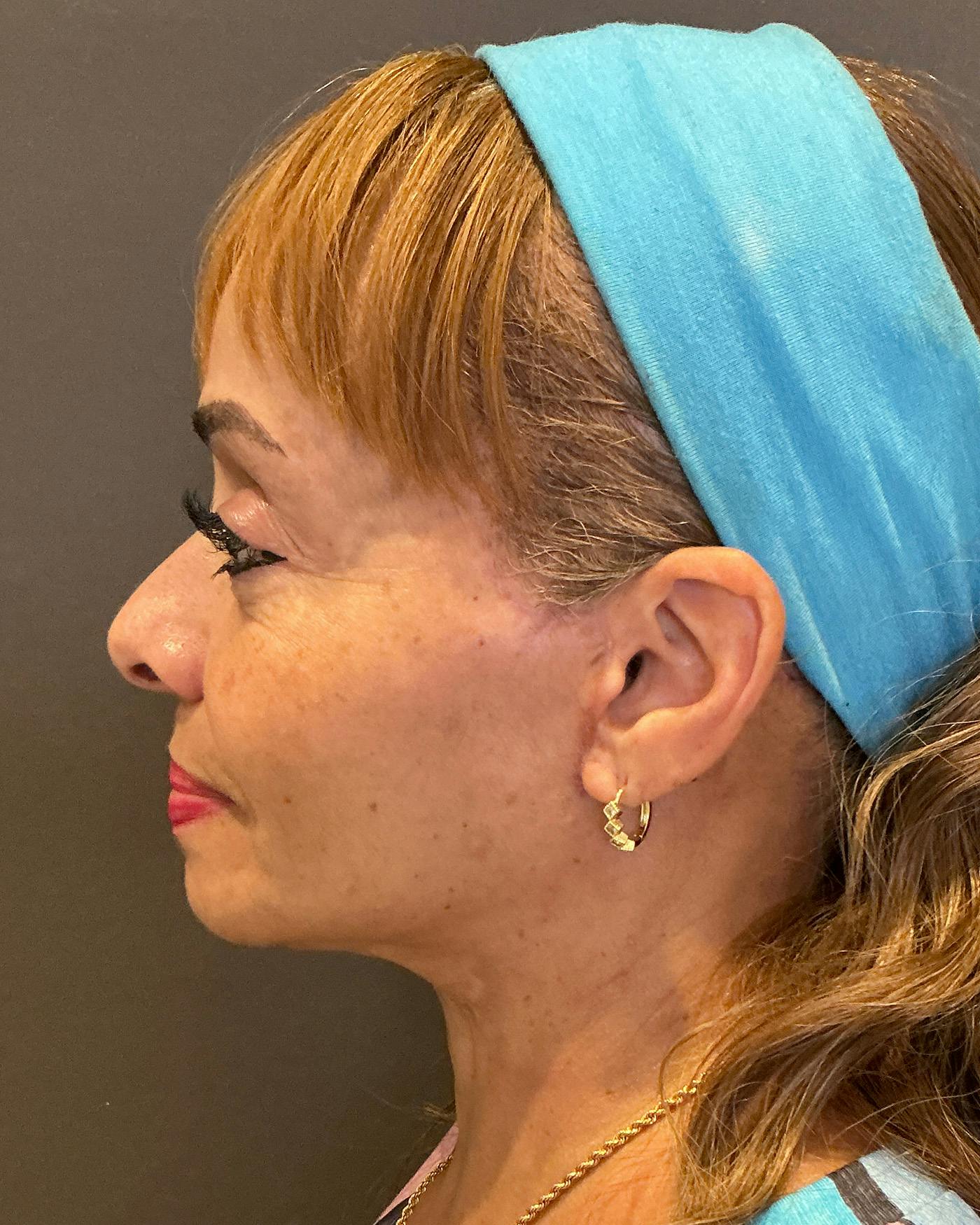 Facial Fat Transfer Before & After Gallery - Patient 256345 - Image 10