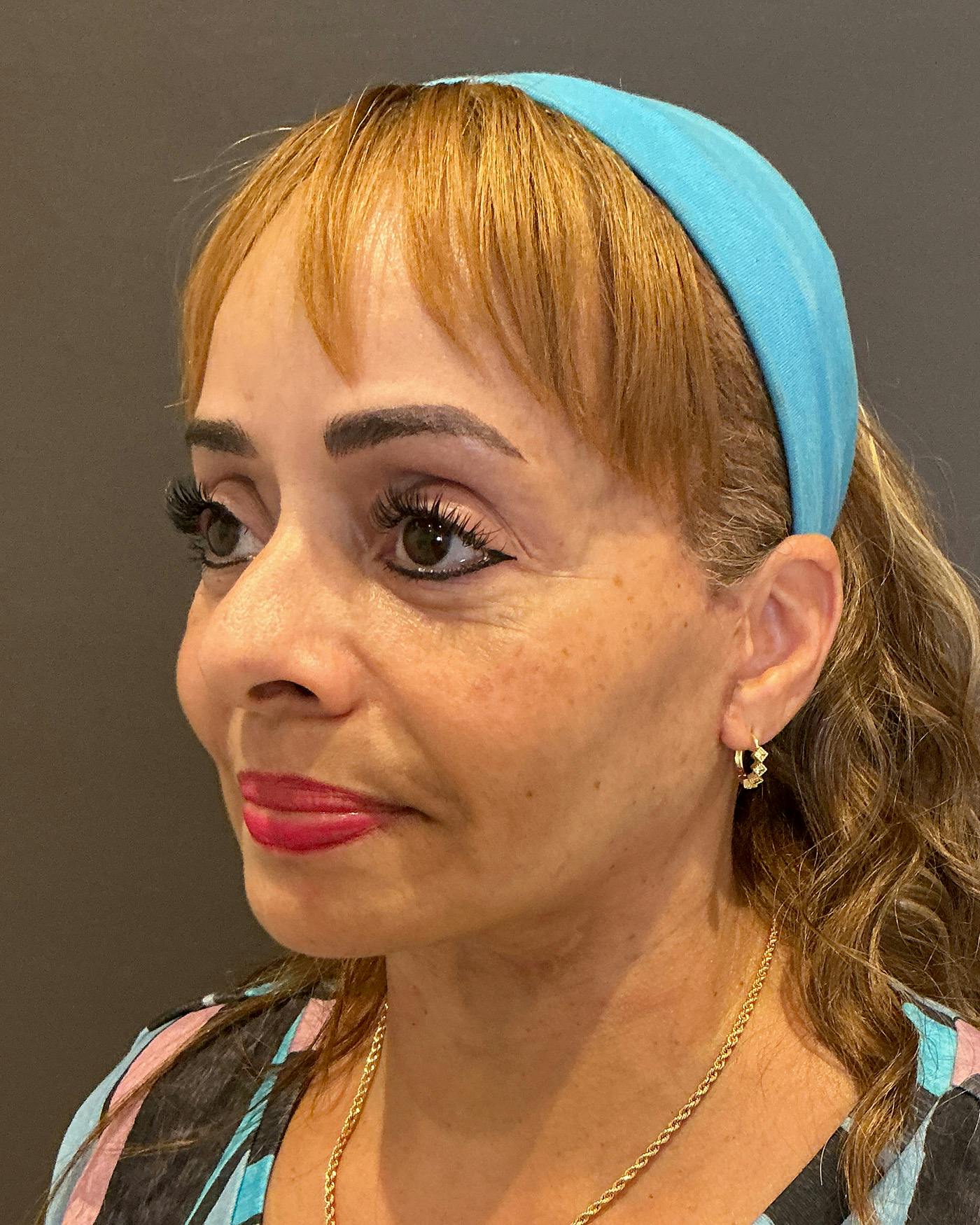 Facial Fat Transfer Before & After Gallery - Patient 256345 - Image 8
