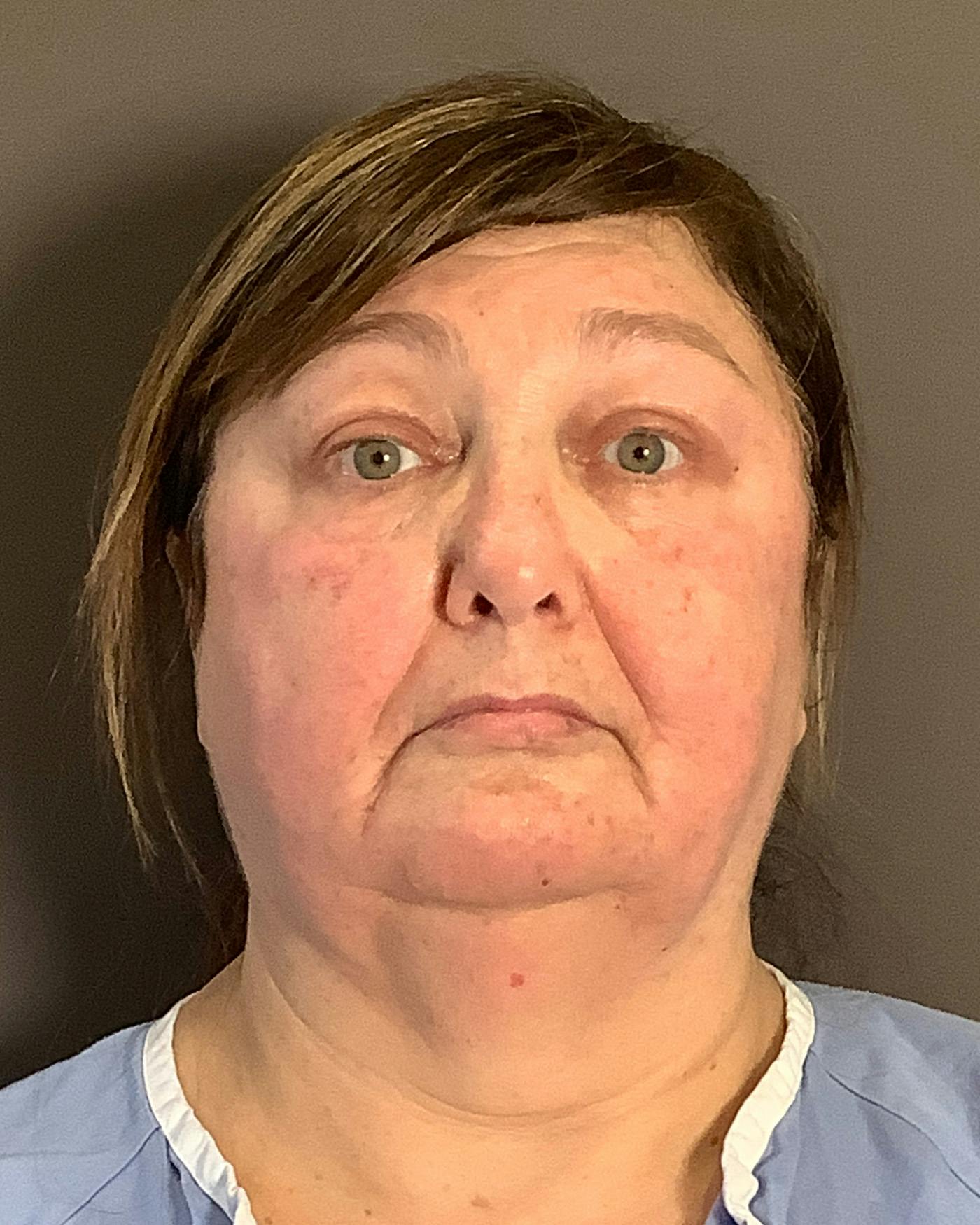 Facelifts / Necklift Before & After Gallery - Patient 458686 - Image 1
