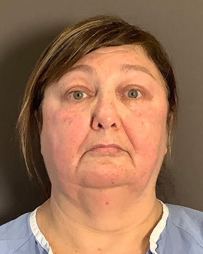 Facelifts / Necklift Before & After Gallery - Patient 458686 - Image 1