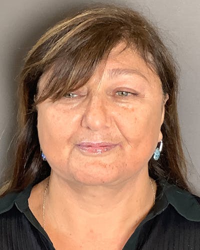 Facelifts / Necklift Before & After Gallery - Patient 458686 - Image 2
