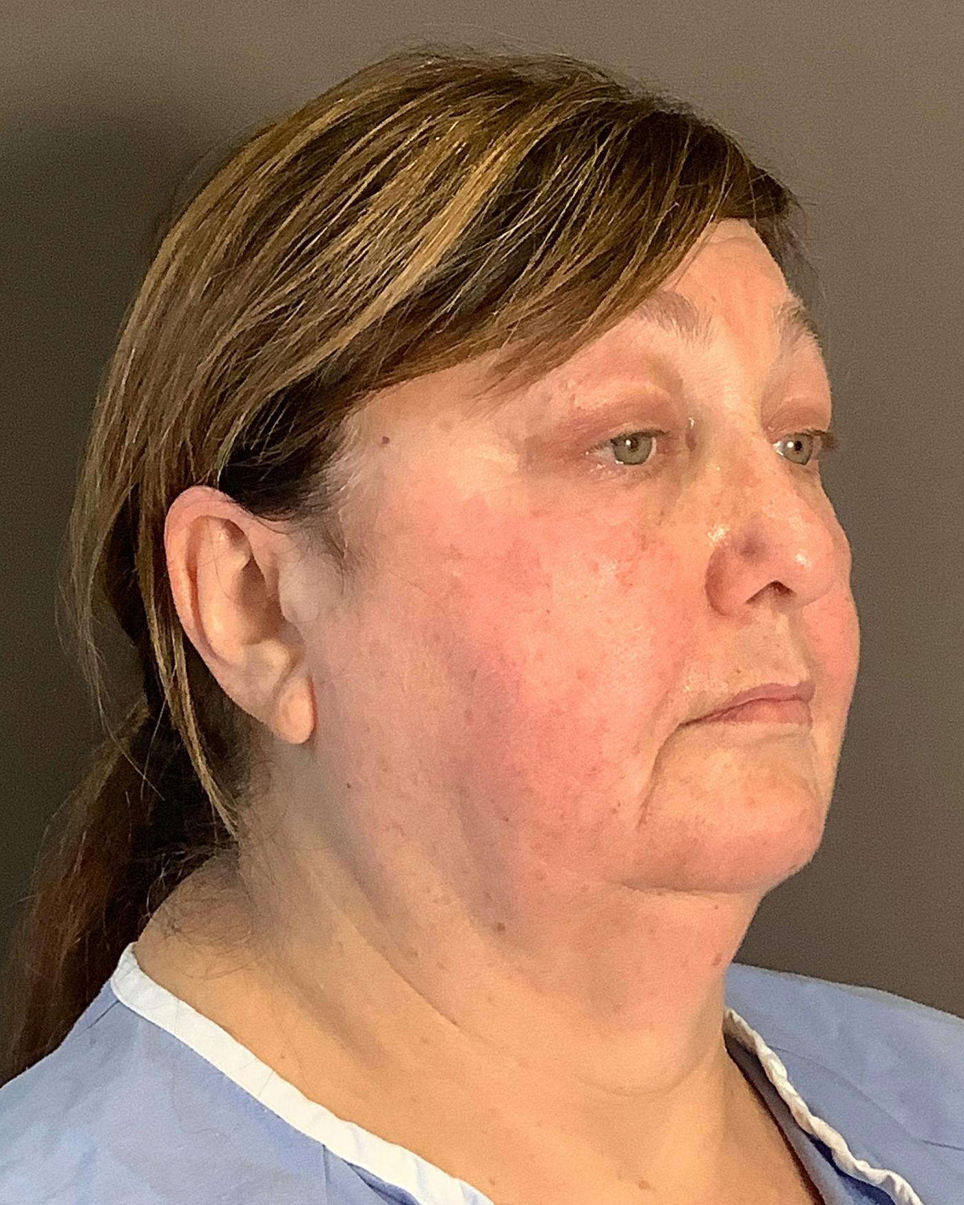 Facelifts / Necklift Before & After Gallery - Patient 458686 - Image 3
