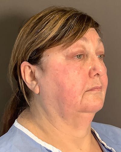 Facelifts / Necklift Before & After Gallery - Patient 458686 - Image 1