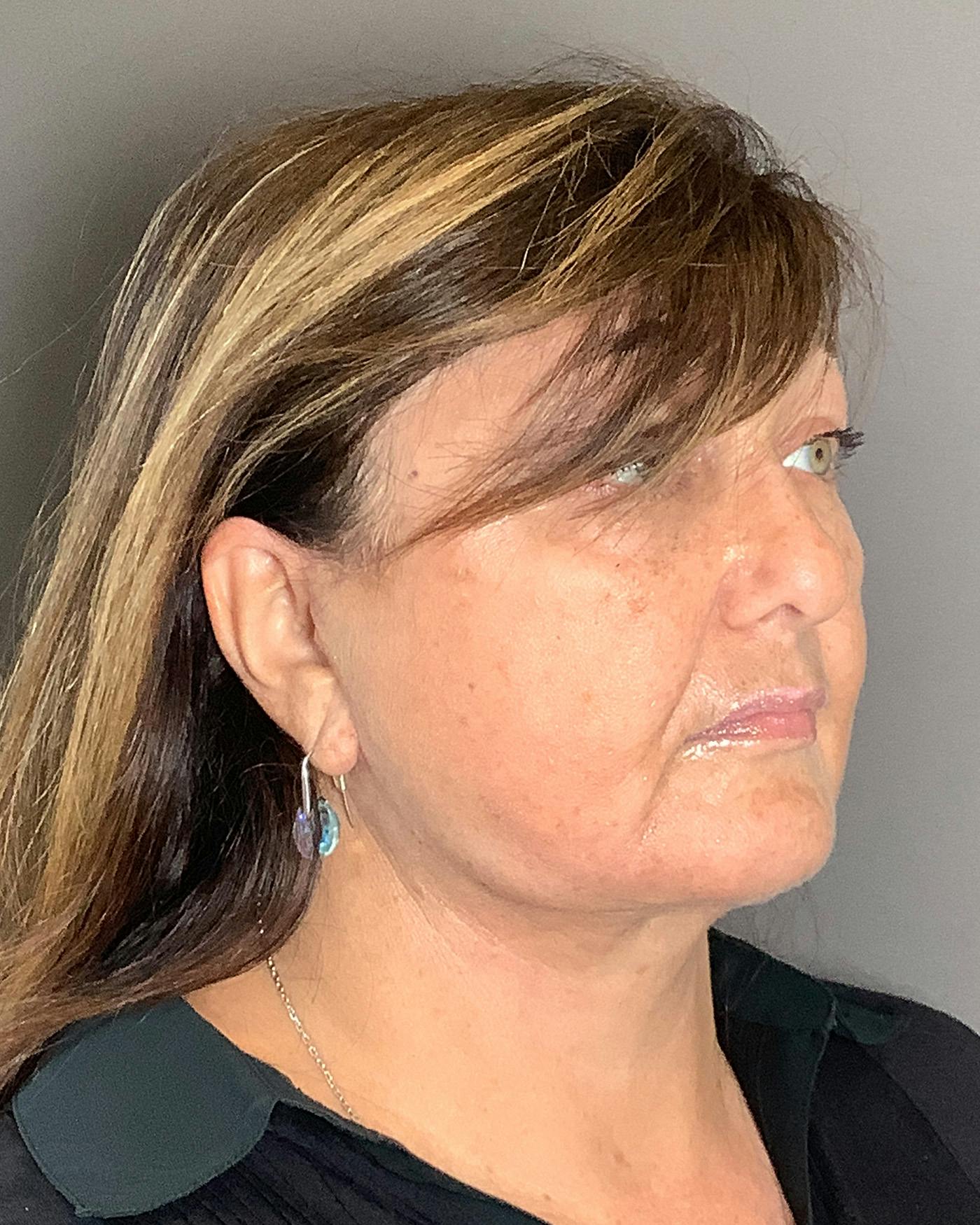 Facelifts / Necklift Before & After Gallery - Patient 458686 - Image 4