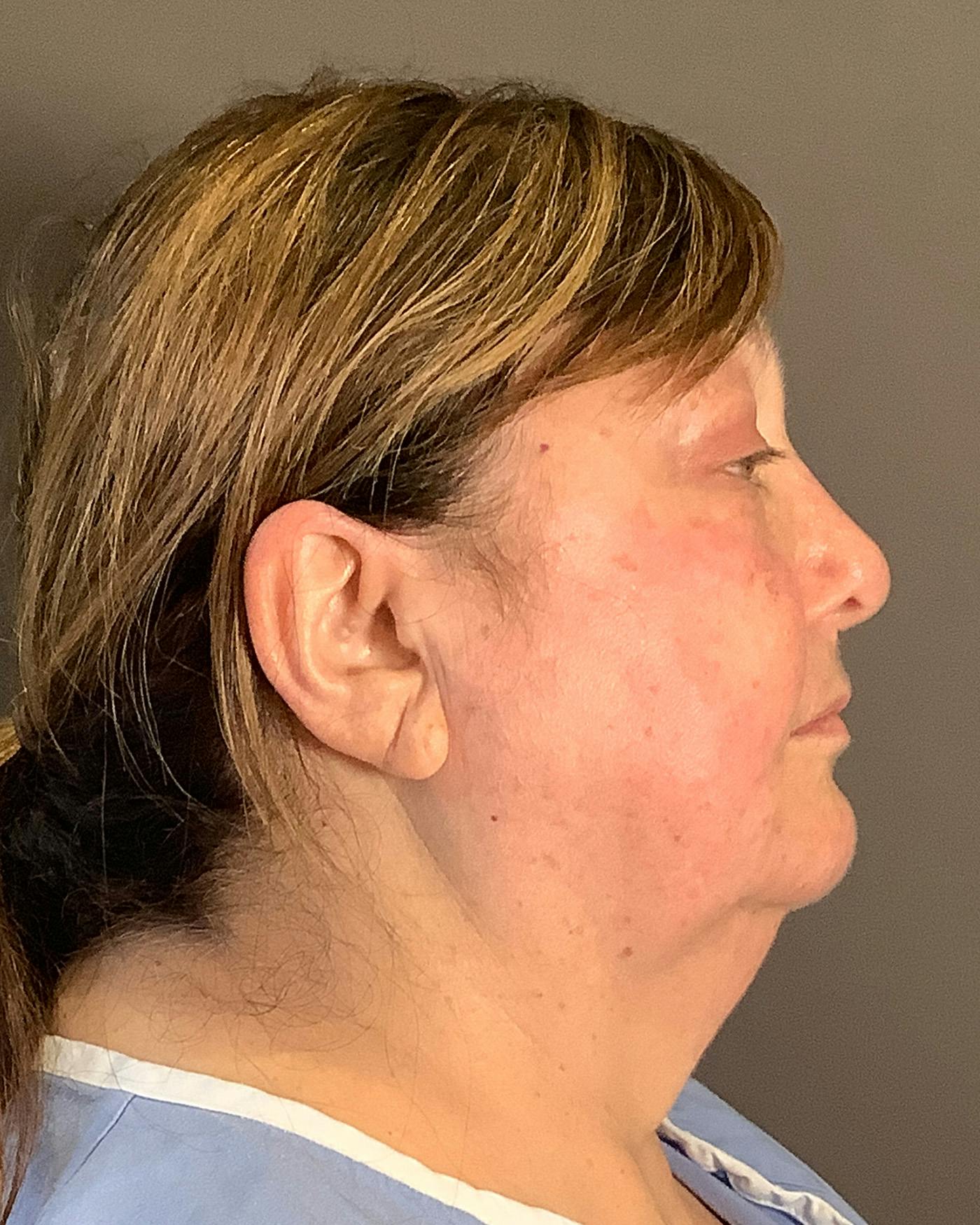Facelifts / Necklift Before & After Gallery - Patient 458686 - Image 5