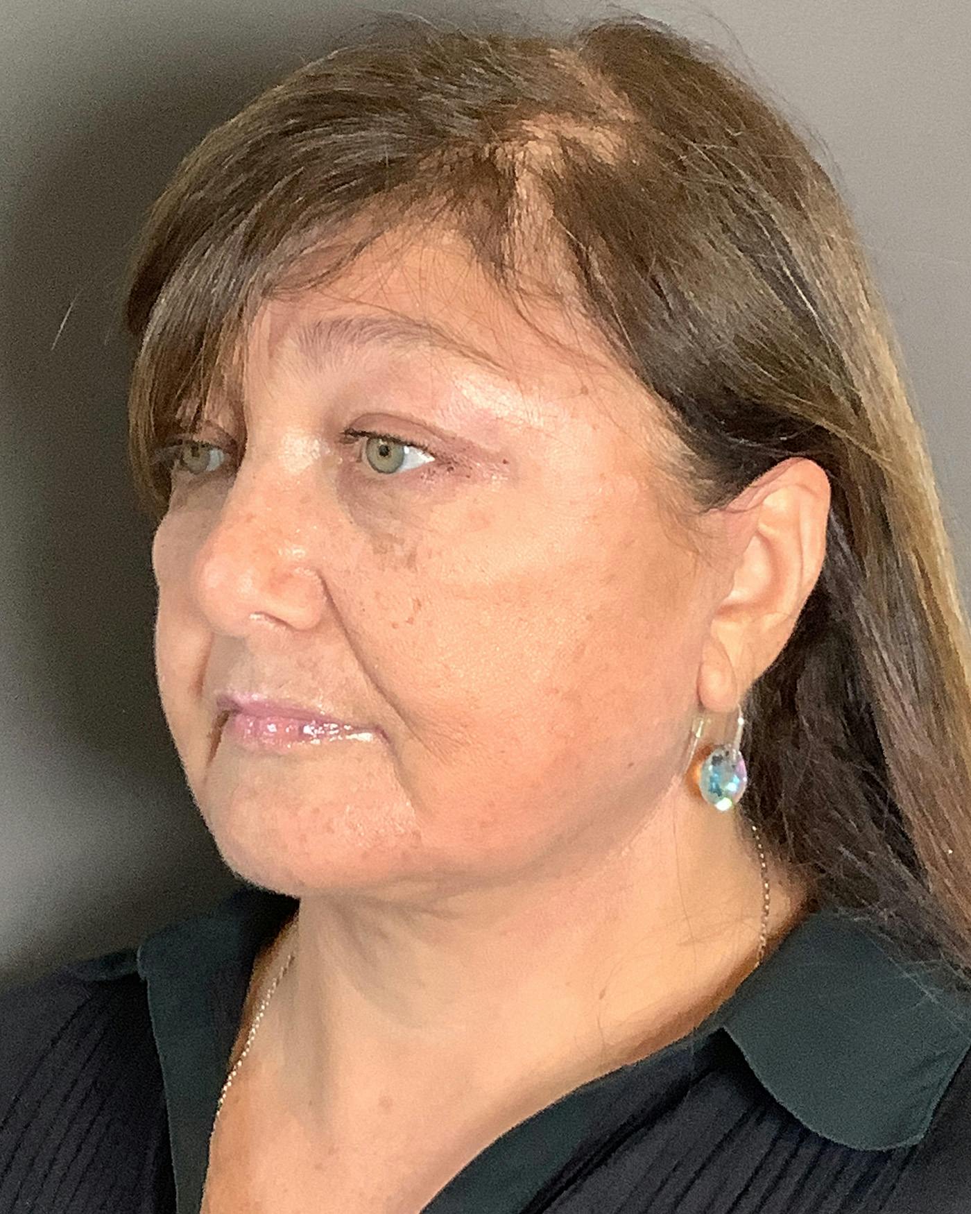Facelifts / Necklift Before & After Gallery - Patient 458686 - Image 8