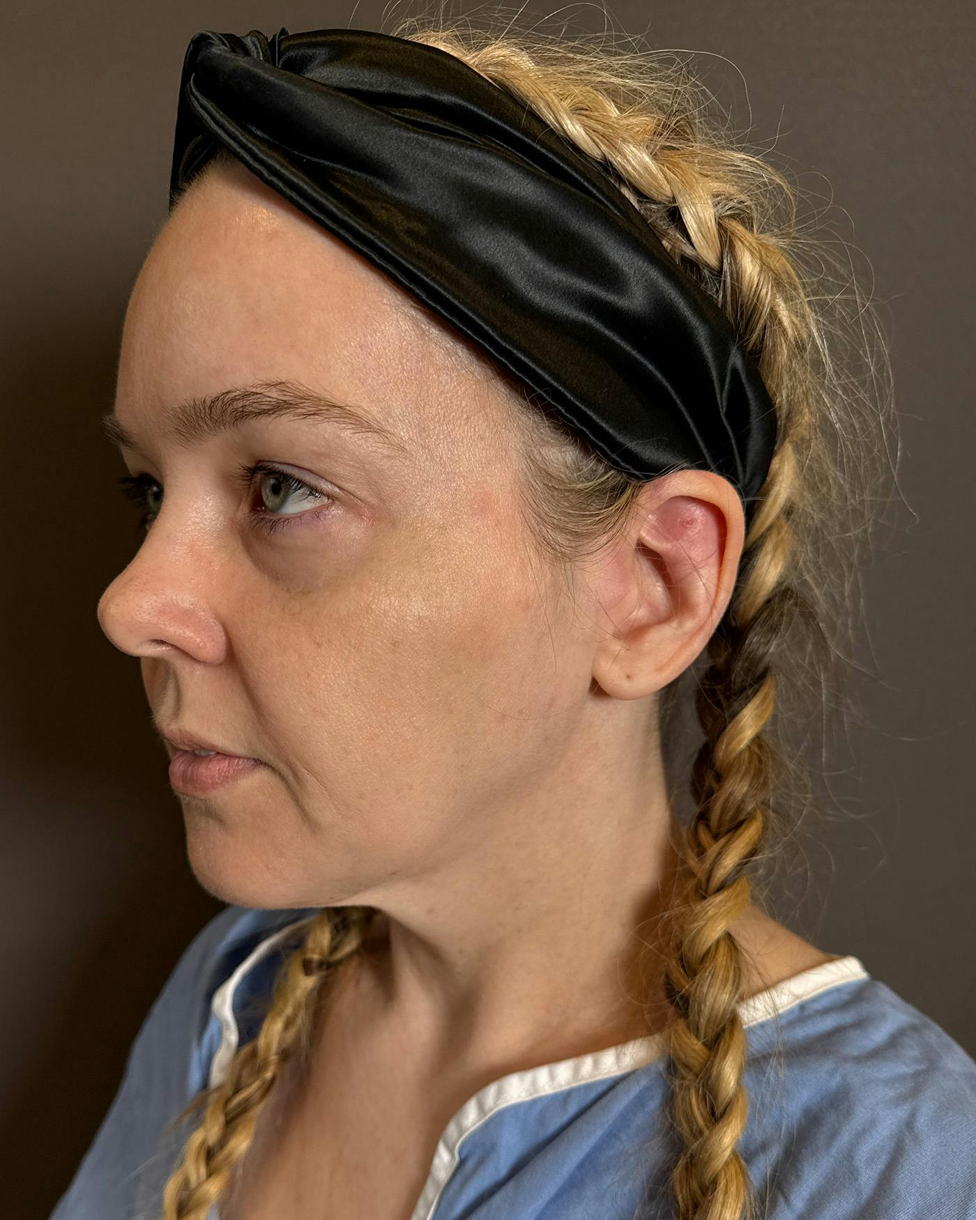 Facelifts / Necklift Before & After Gallery - Patient 191782 - Image 7