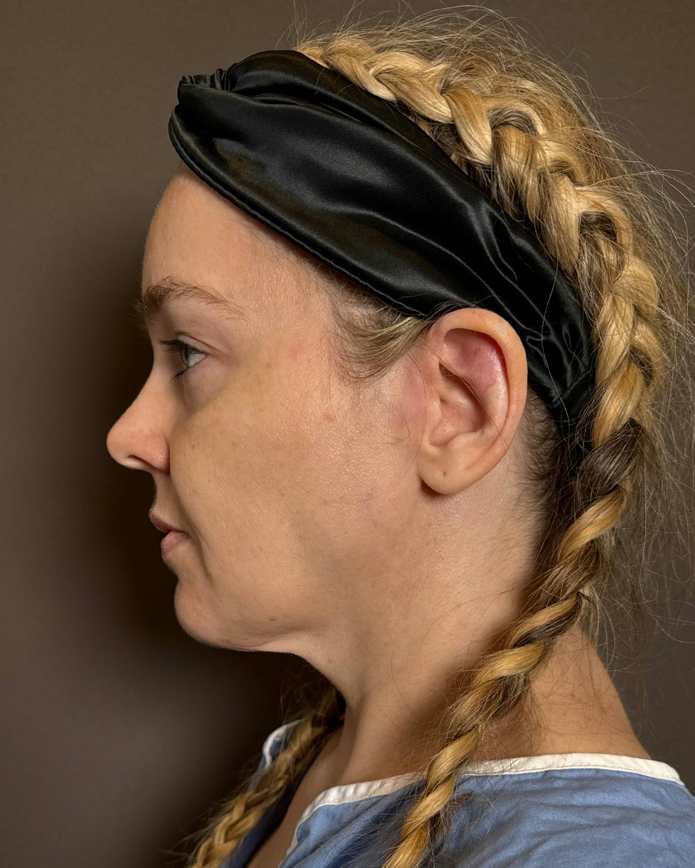 Facelifts / Necklift Before & After Gallery - Patient 191782 - Image 9