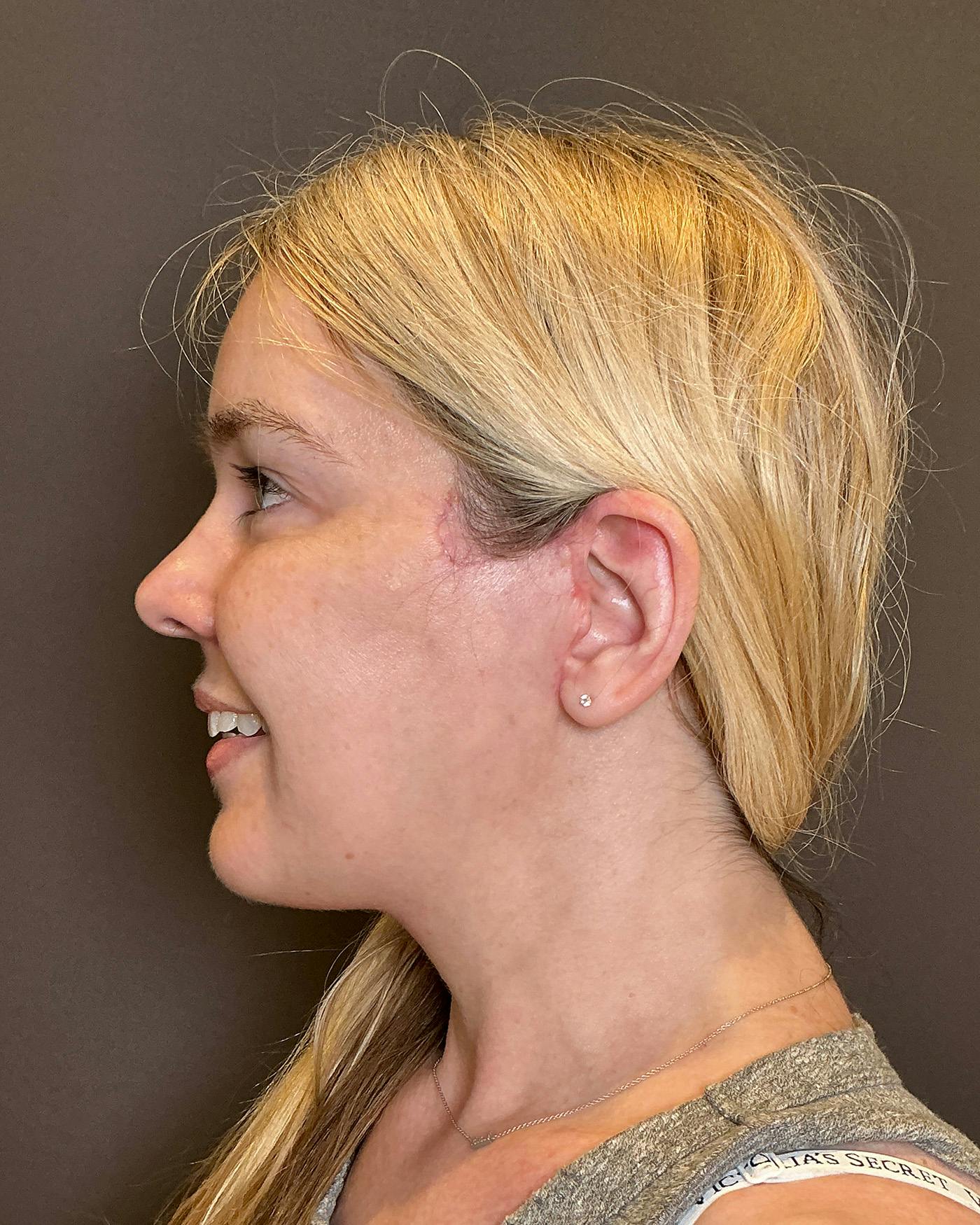 Facelifts / Necklift Before & After Gallery - Patient 191782 - Image 10