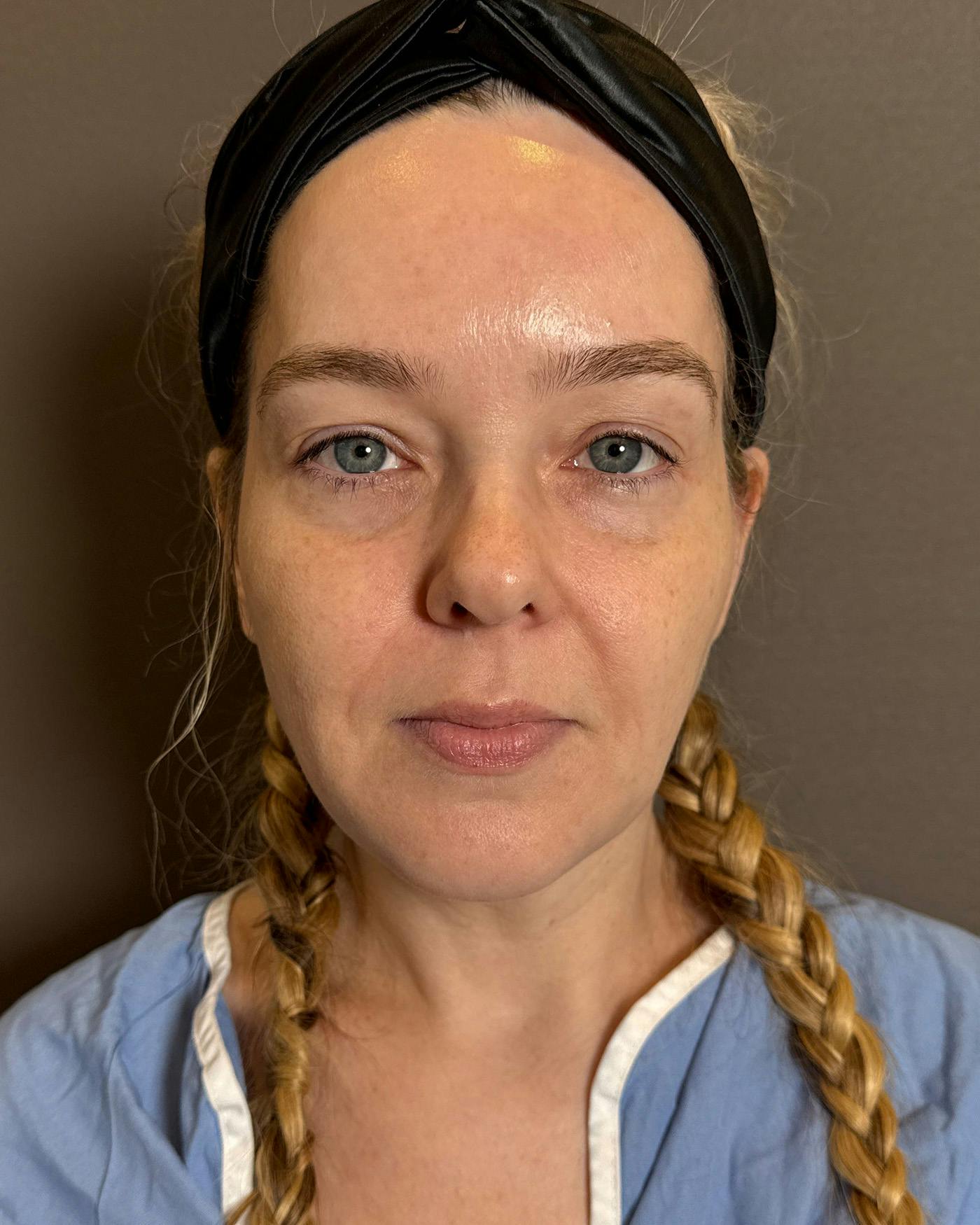 Facelifts / Necklift Before & After Gallery - Patient 191782 - Image 1