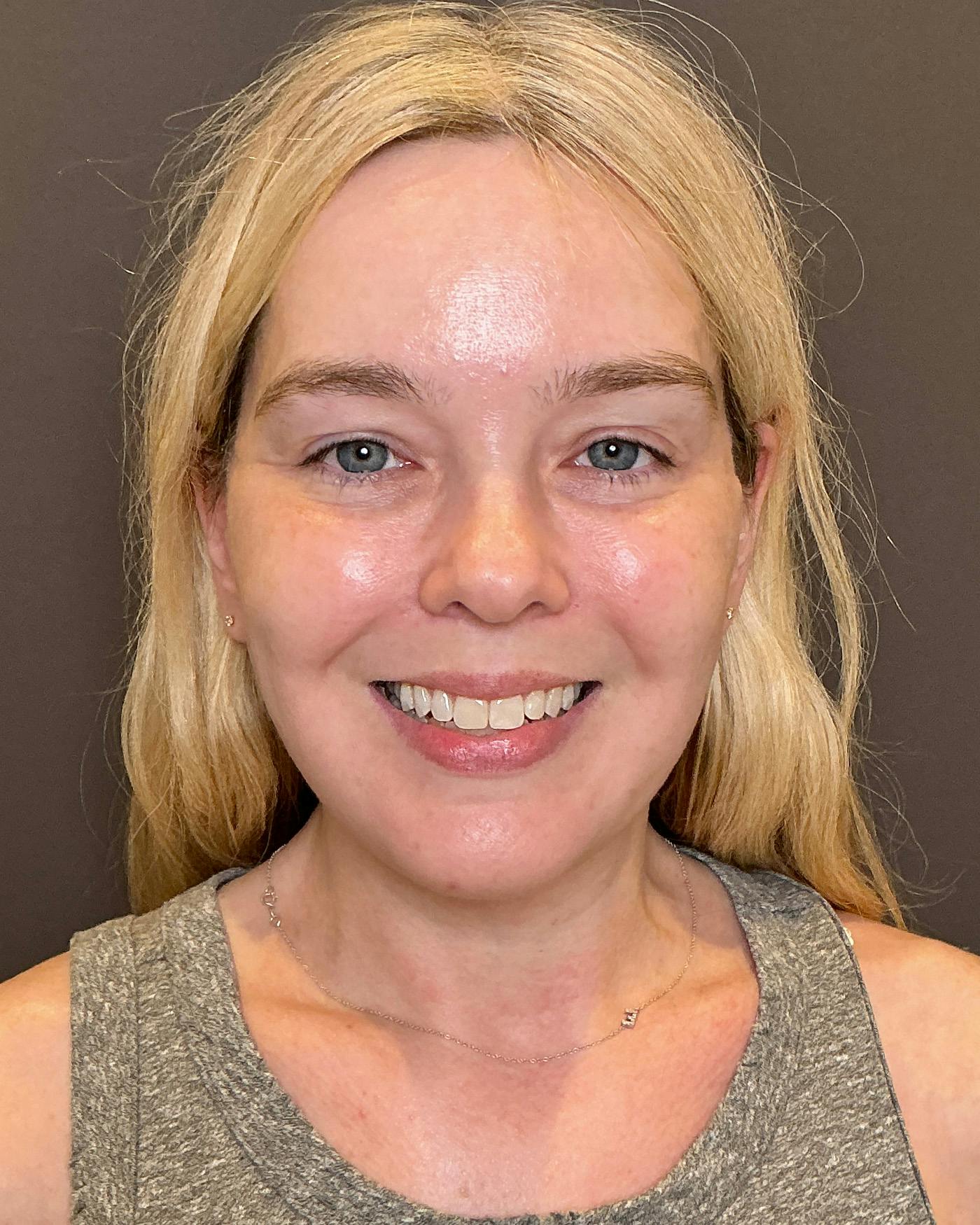 Facelifts / Necklift Before & After Gallery - Patient 191782 - Image 2