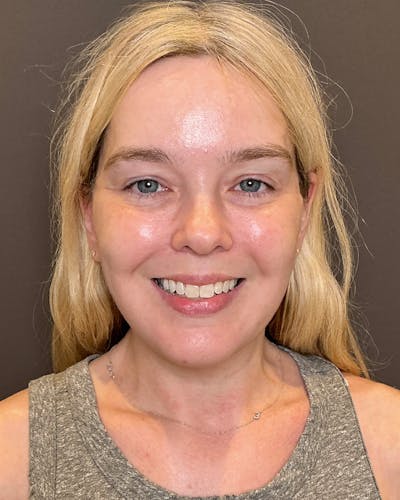 Facelifts / Necklift Before & After Gallery - Patient 191782 - Image 2