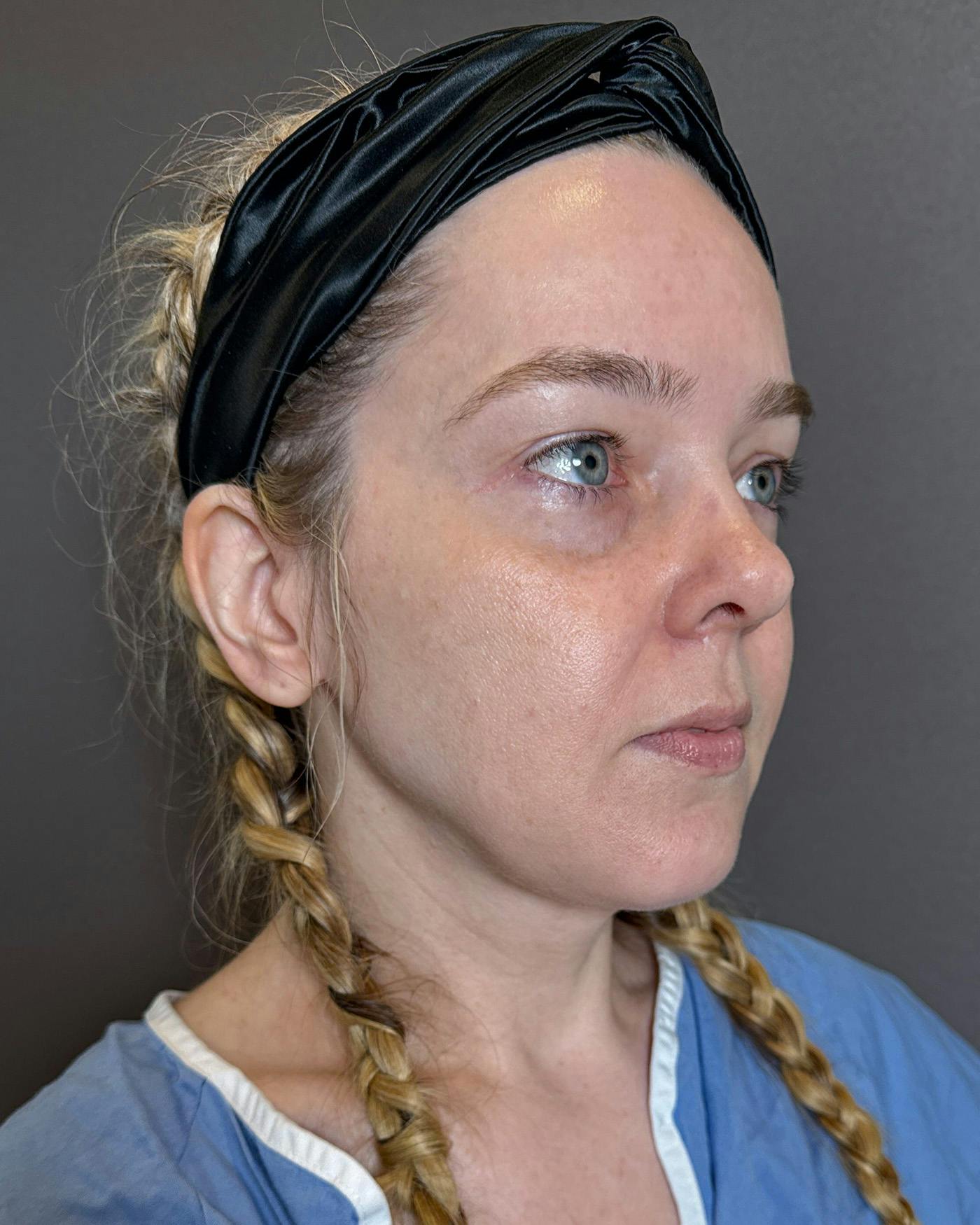 Facelifts / Necklift Before & After Gallery - Patient 191782 - Image 3
