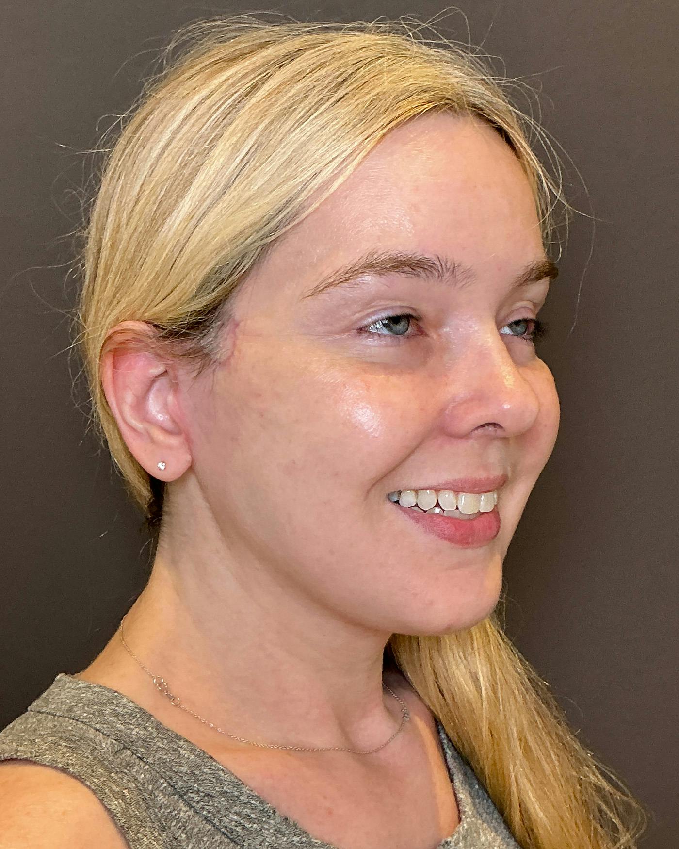Facelifts / Necklift Before & After Gallery - Patient 191782 - Image 4