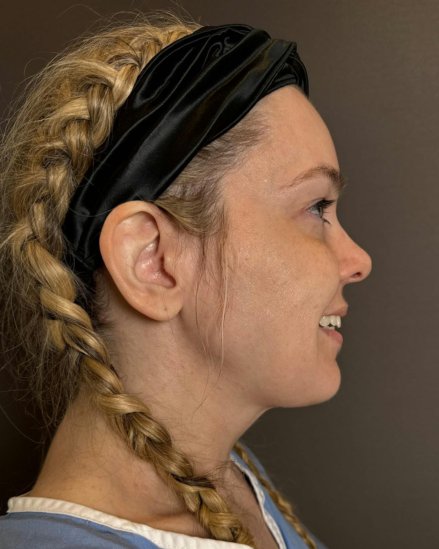 Facelifts / Necklift Before & After Gallery - Patient 191782 - Image 5