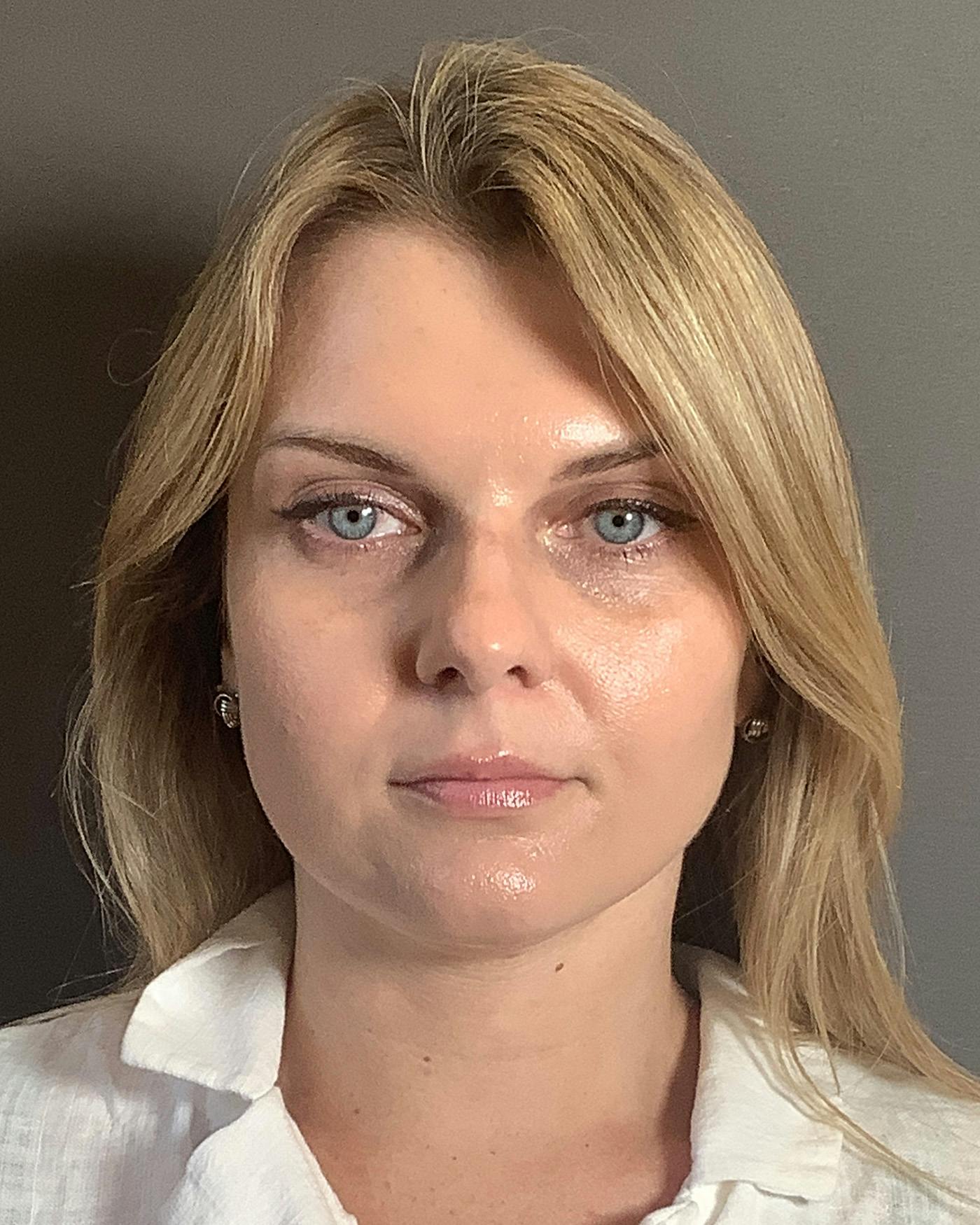 Rhinoplasty Before & After Gallery - Patient 213100 - Image 5