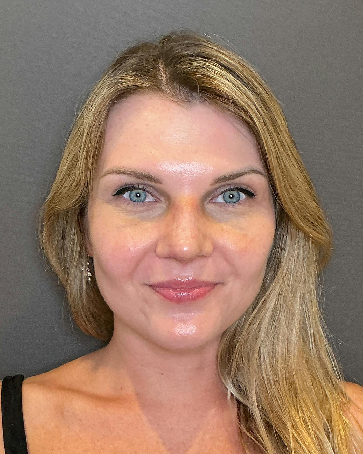 Rhinoplasty Before & After Gallery - Patient 213100 - Image 6
