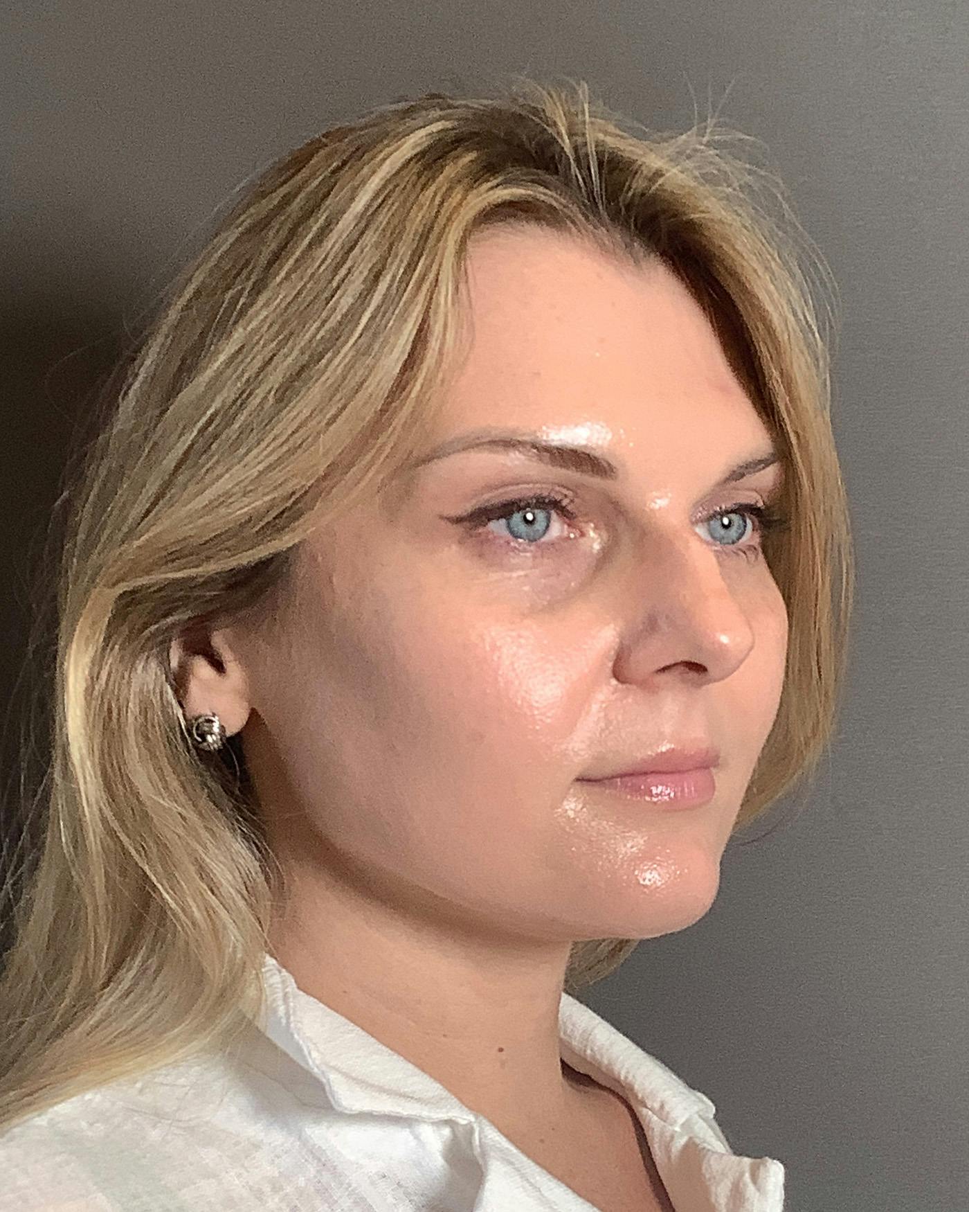 Rhinoplasty Before & After Gallery - Patient 213100 - Image 3