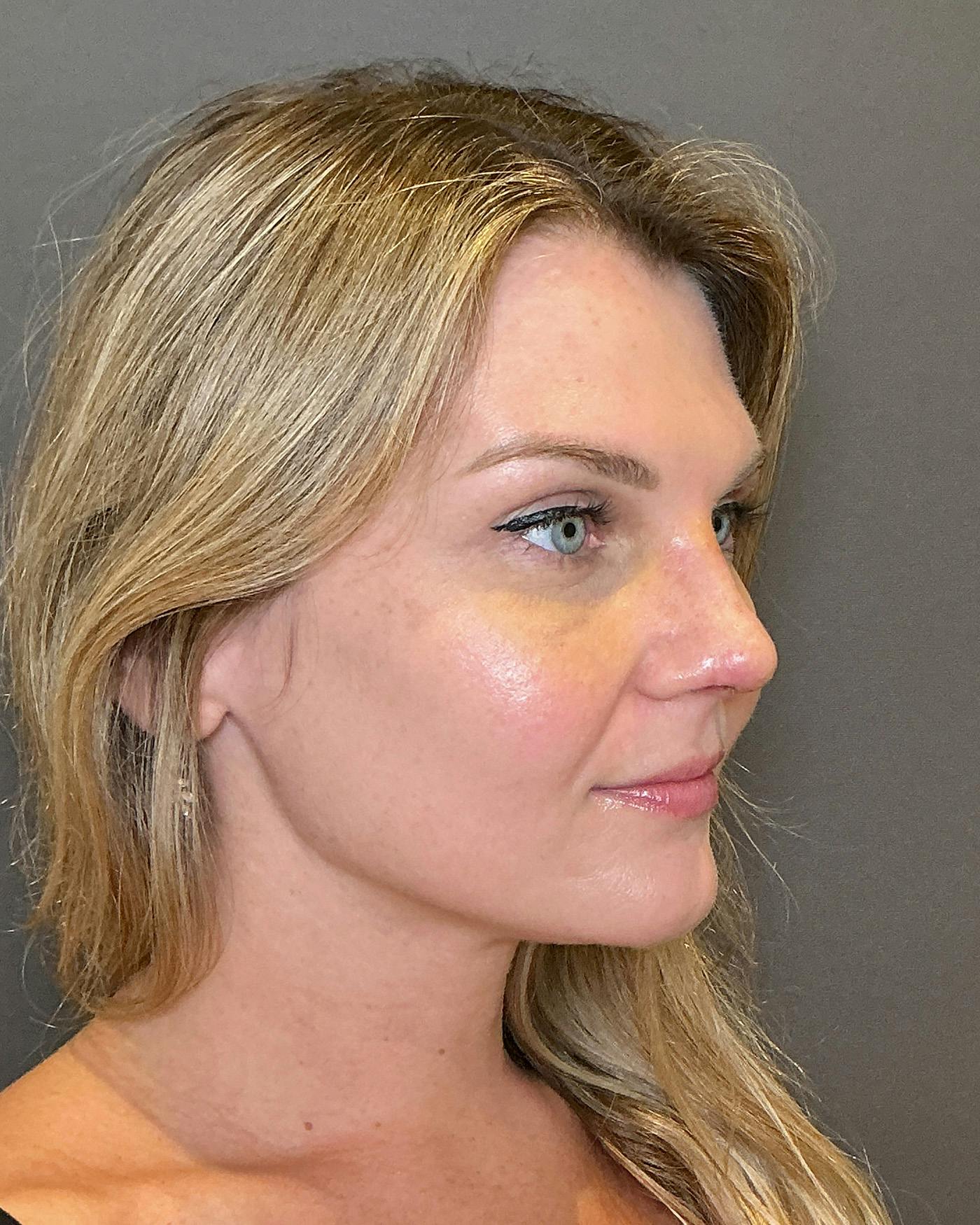 Rhinoplasty Before & After Gallery - Patient 213100 - Image 4