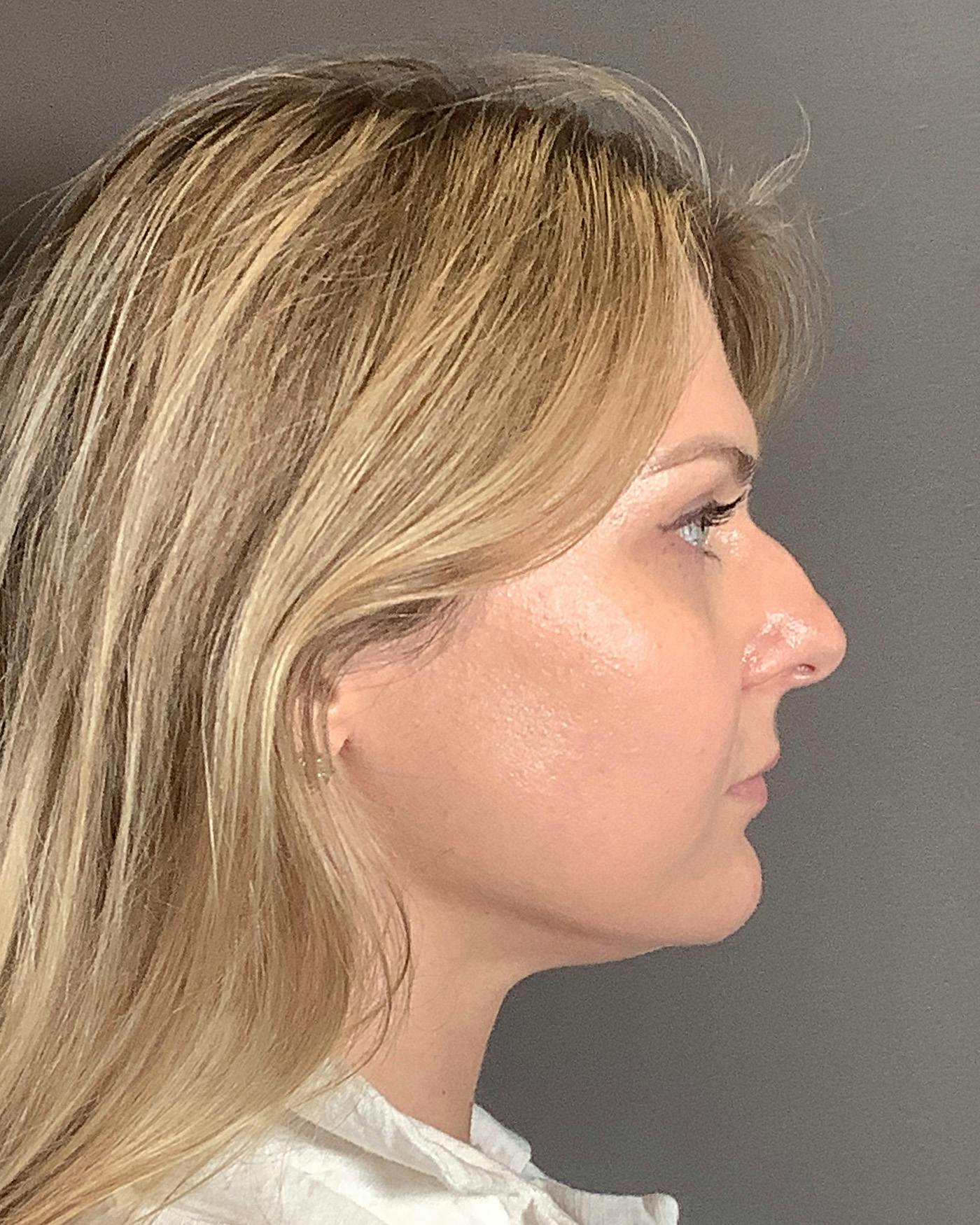 Rhinoplasty Before & After Gallery - Patient 213100 - Image 1