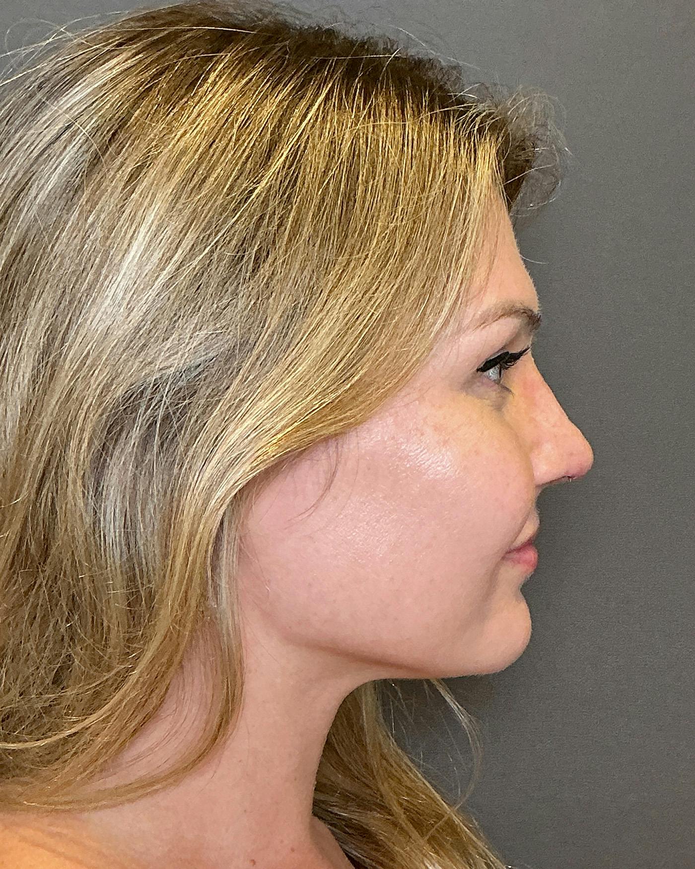 Rhinoplasty Before & After Gallery - Patient 213100 - Image 2