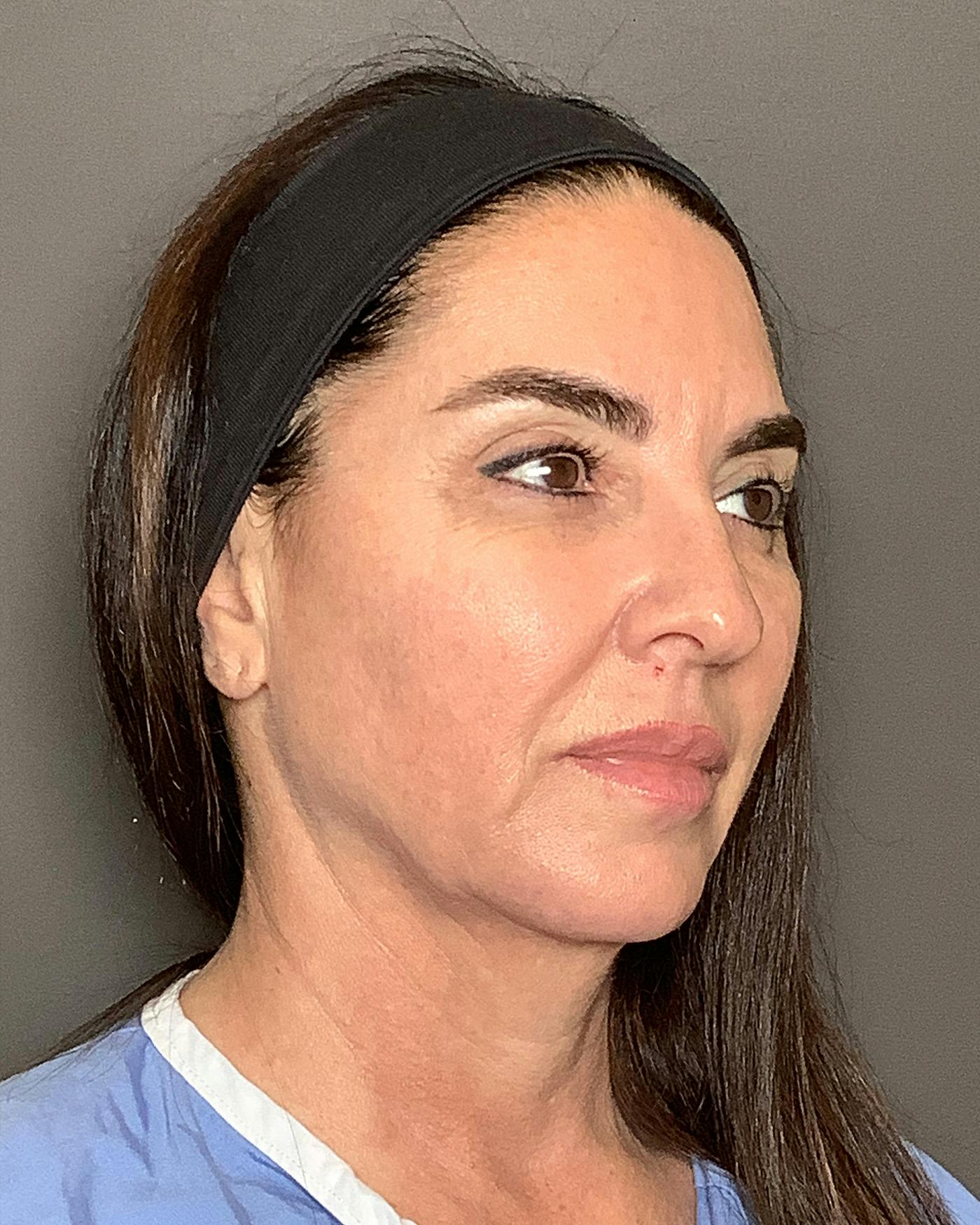 CO2 Full Face Before & After Gallery - Patient 458833 - Image 3