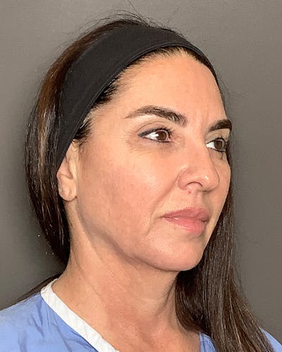 Facelifts / Necklift Before & After Gallery - Patient 283733 - Image 1