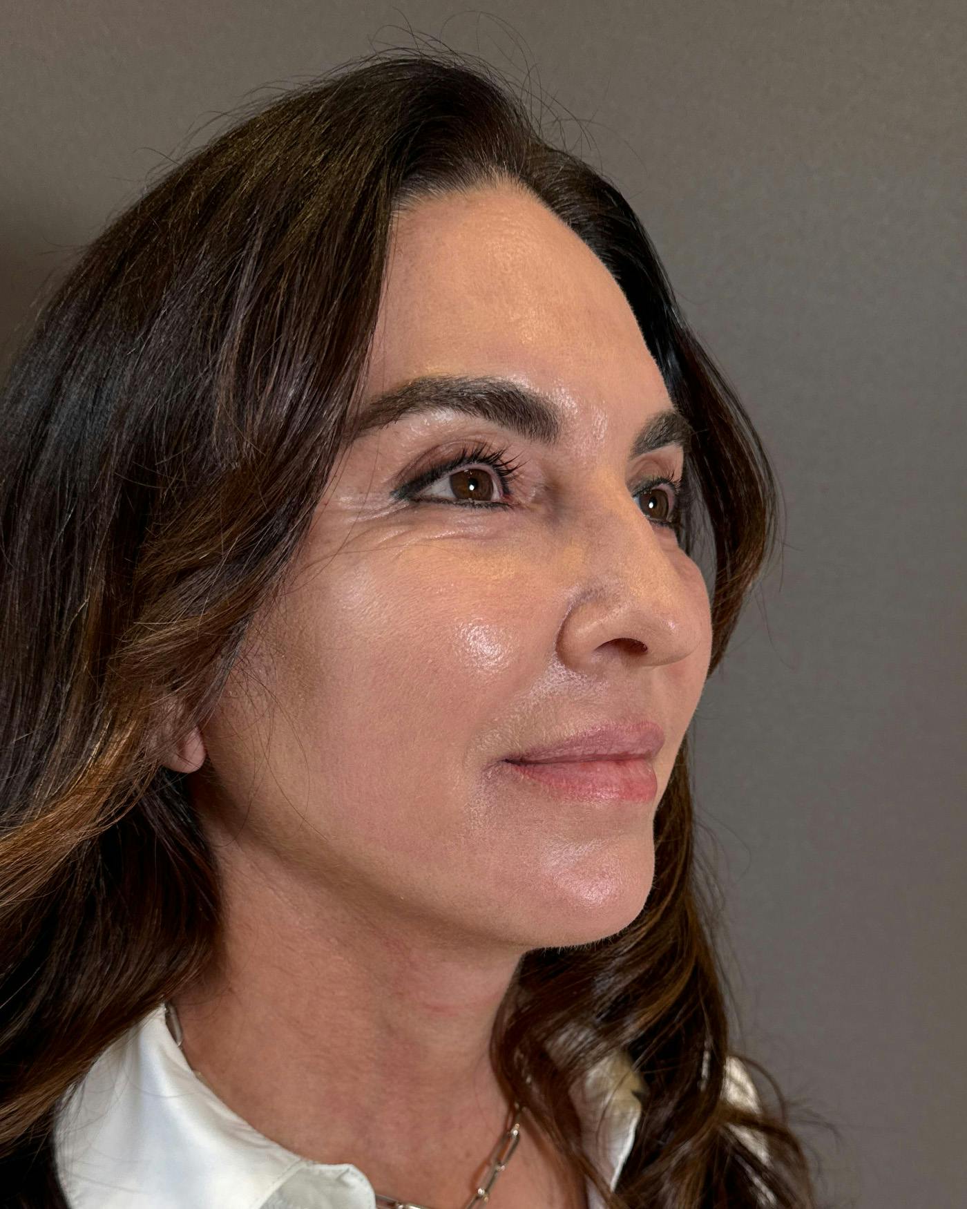 CO2 Full Face Before & After Gallery - Patient 458833 - Image 4