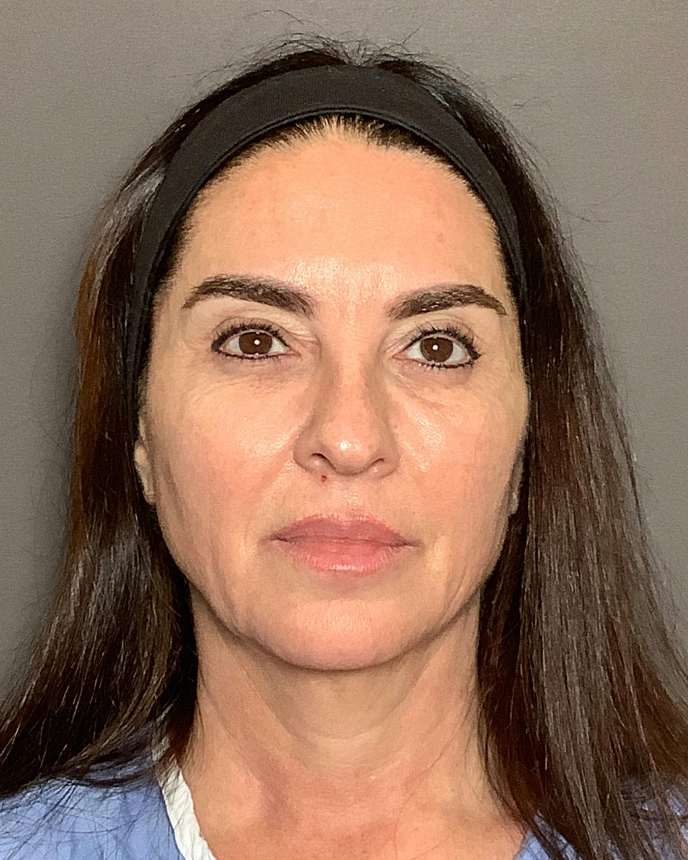 CO2 Full Face Before & After Gallery - Patient 458833 - Image 1