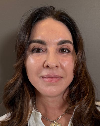 Facelifts / Necklift Before & After Gallery - Patient 283733 - Image 2