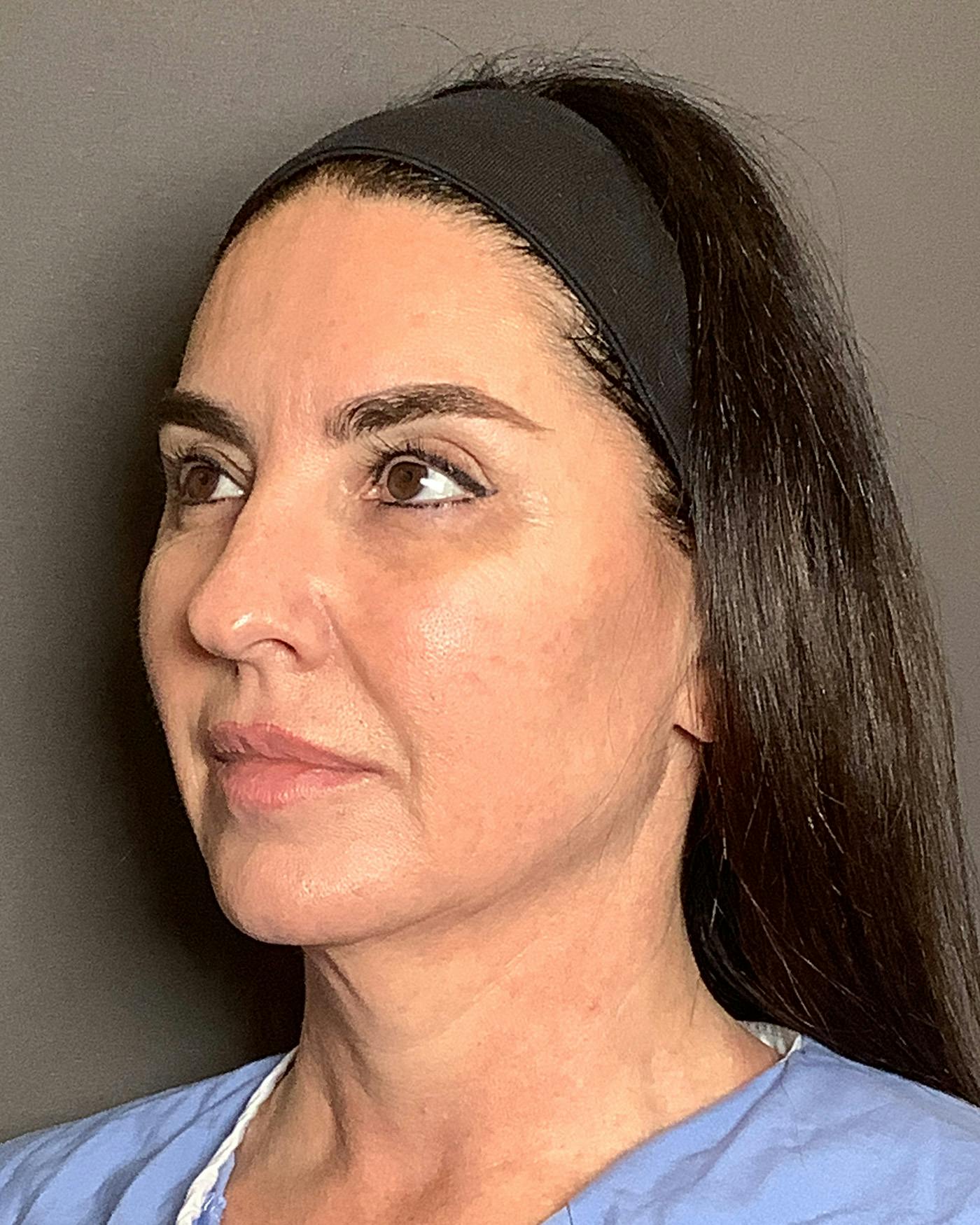 CO2 Full Face Before & After Gallery - Patient 458833 - Image 7