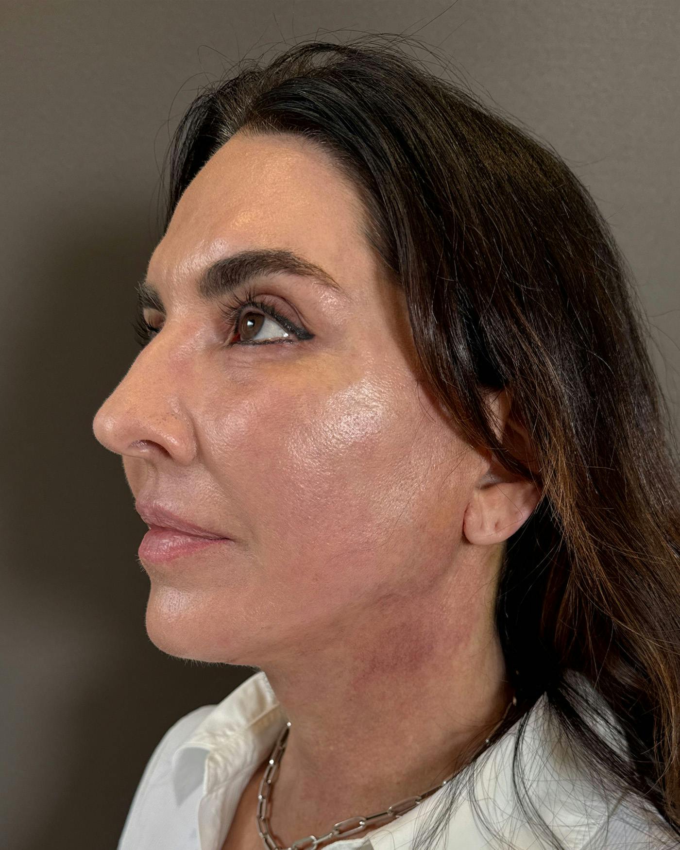 CO2 Full Face Before & After Gallery - Patient 458833 - Image 8