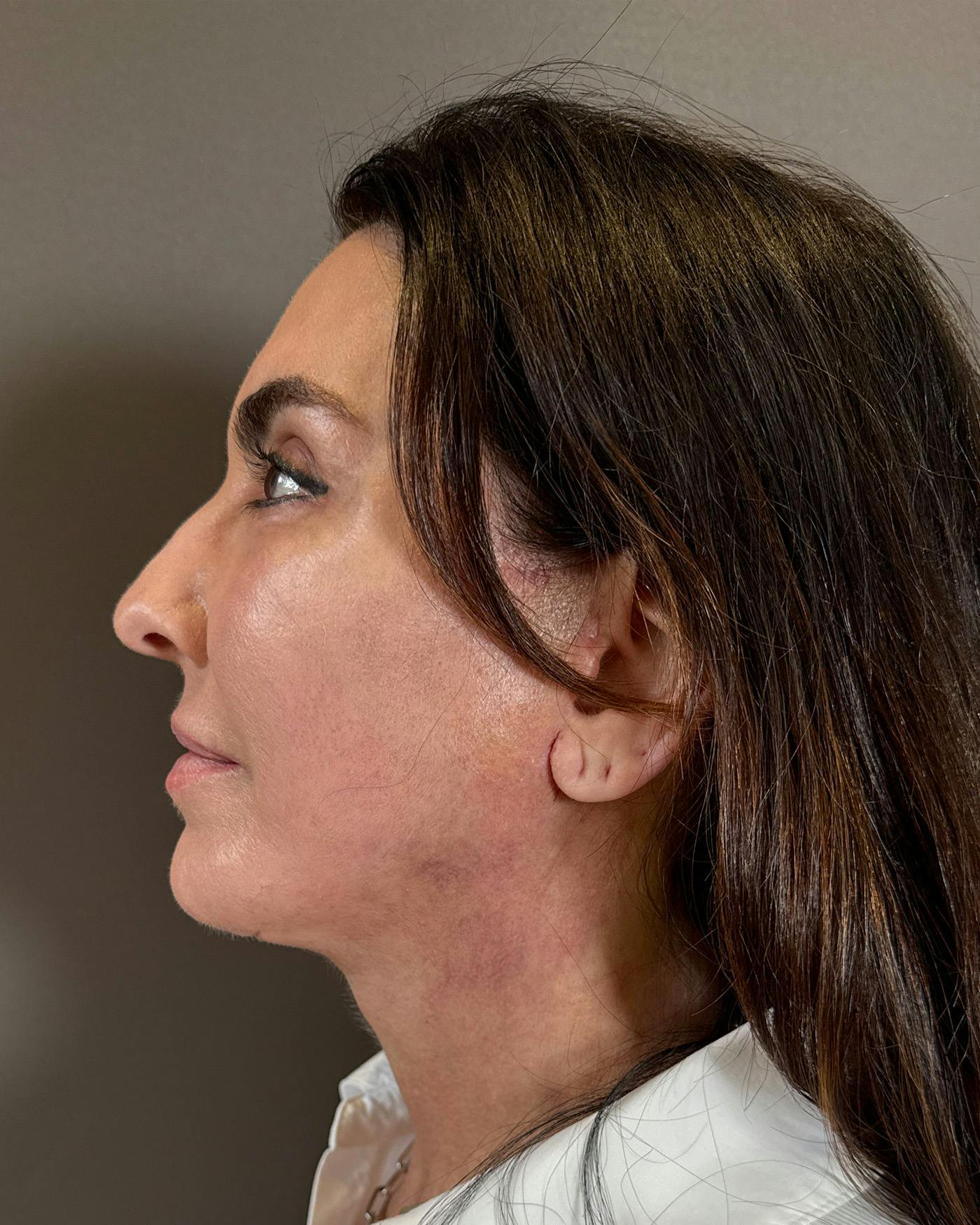 CO2 Full Face Before & After Gallery - Patient 458833 - Image 10