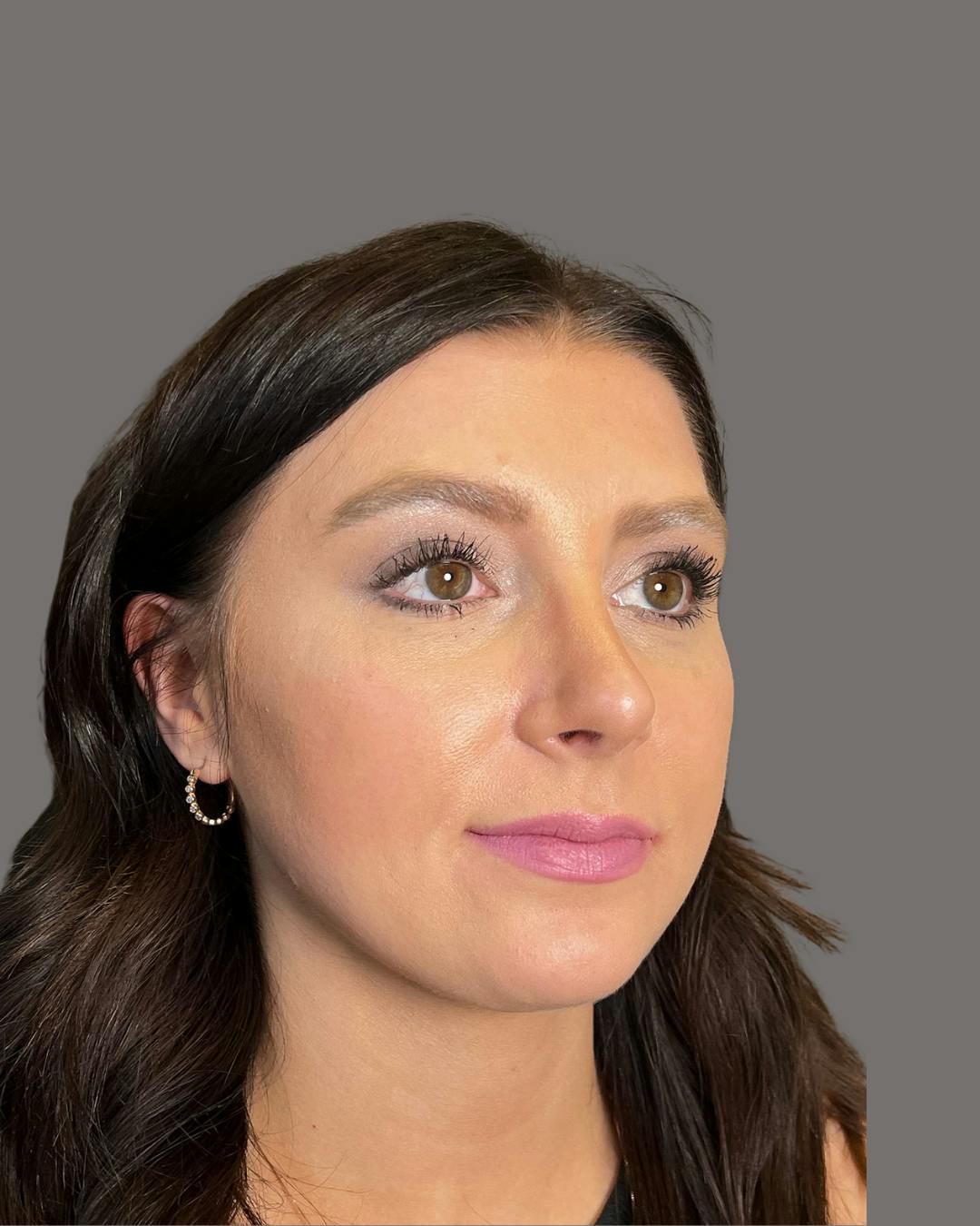 Rhinoplasty Before & After Gallery - Patient 191294715 - Image 4